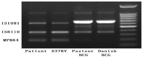 Reagent kit for detecting pathogenic mycobacterium tuberculosis through uniting multiplex PCR, nested-PCR and touch-down PCR