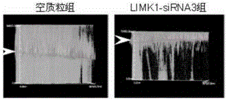 Tumor marker LIMK1 and application thereof
