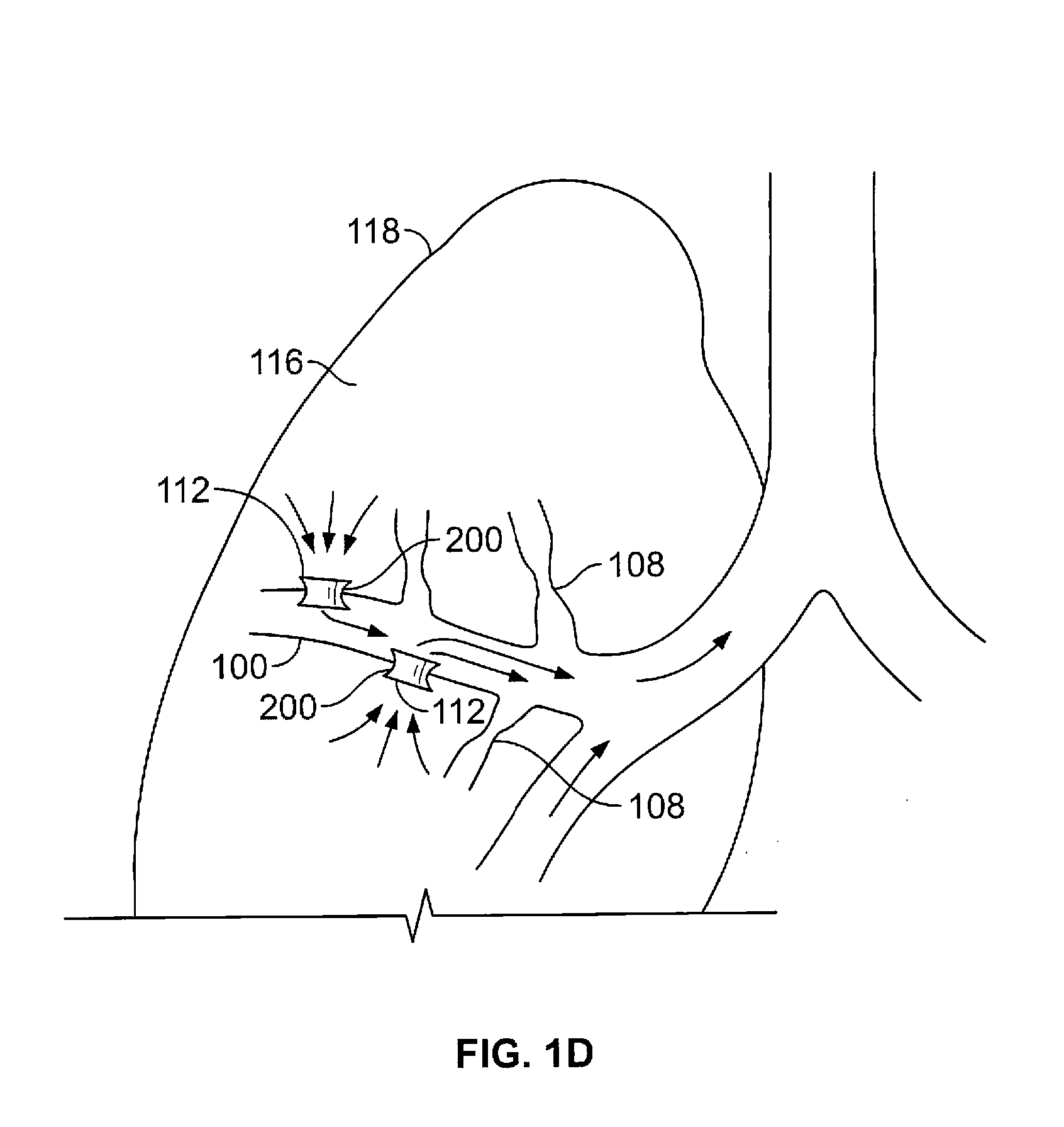 Methods and devices for maintaining surgically created channels in a body organ