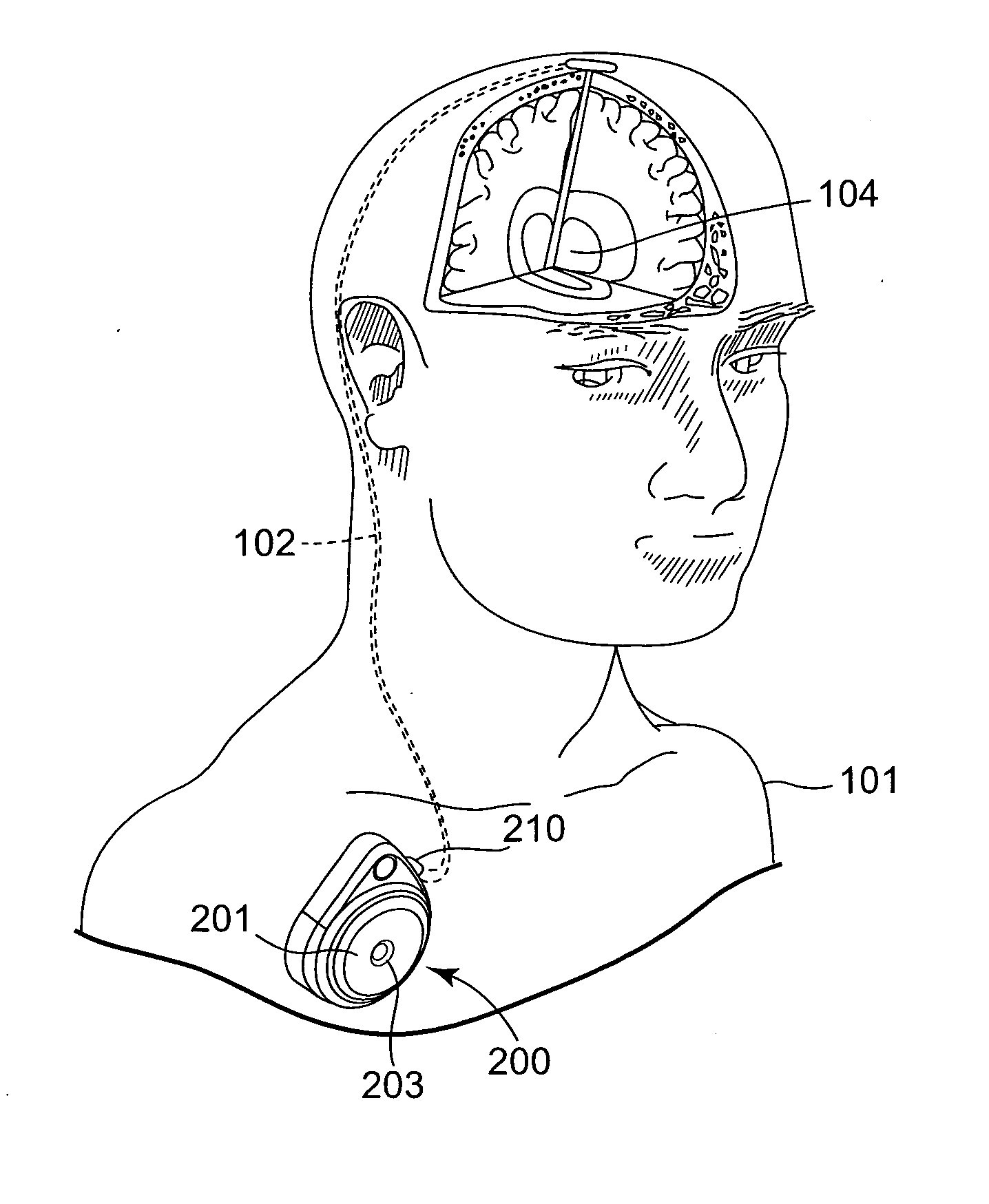 Infusion device with active and passive check valves