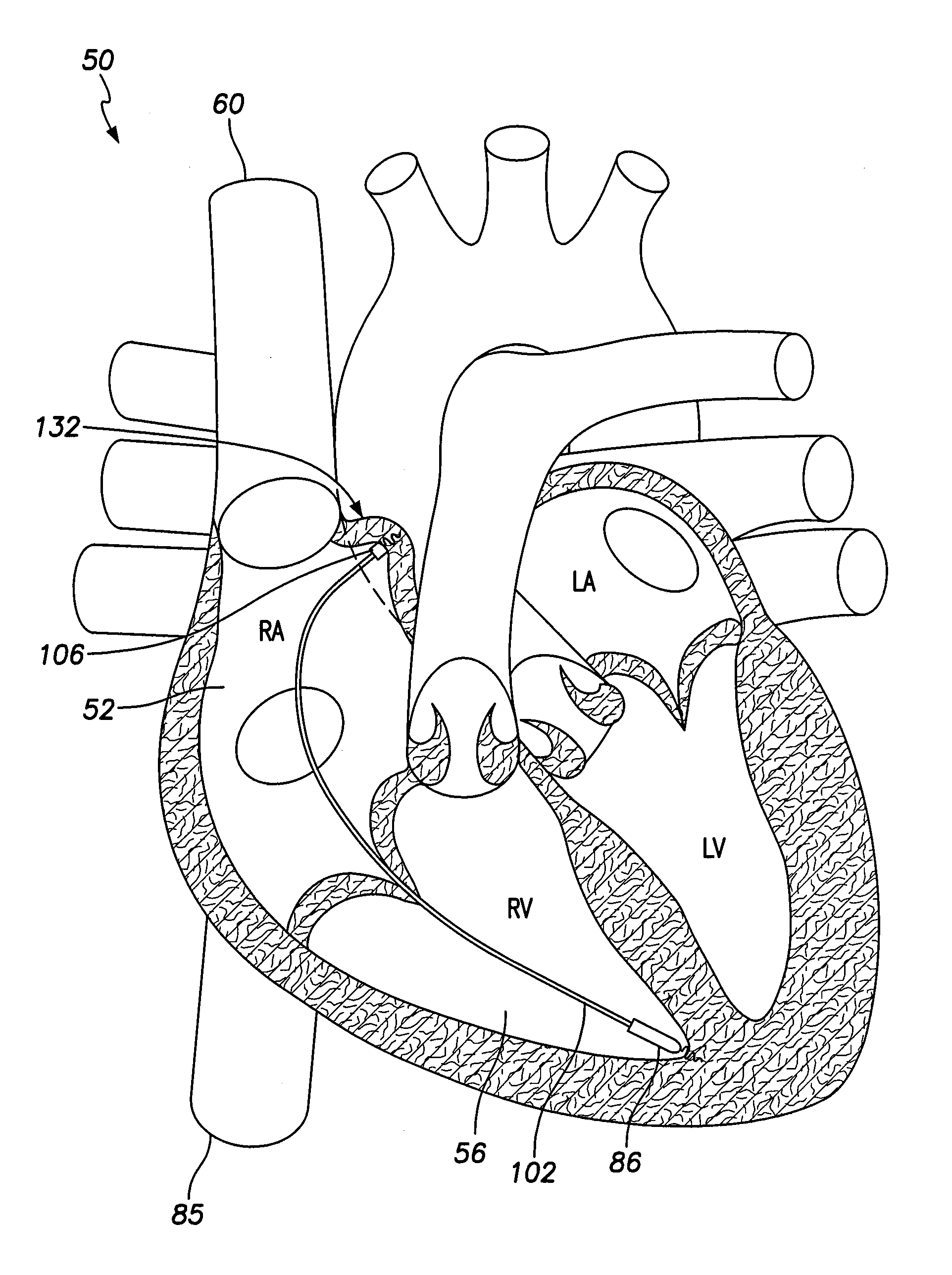 Unitary dual-chamber leadless intra-cardiac medical device and method of implanting same