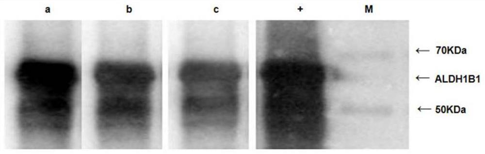 Serum ALDH1B1 autoantibody quantitative detection kit and application thereof