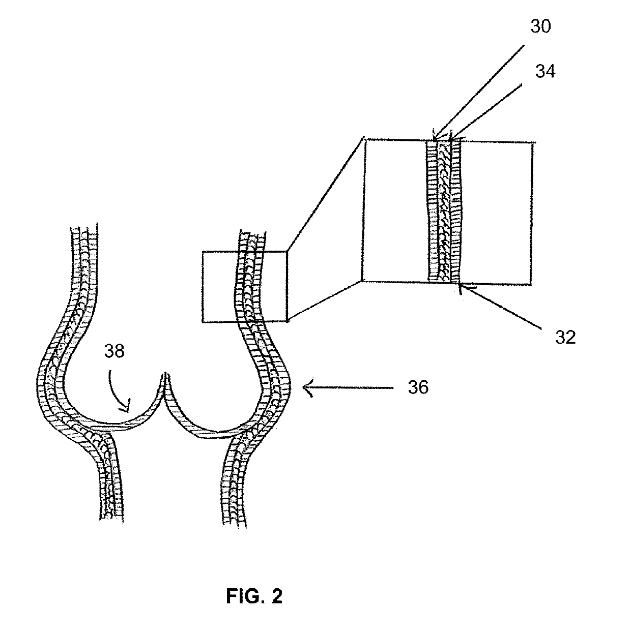 Expandable aortic or pulmonary root