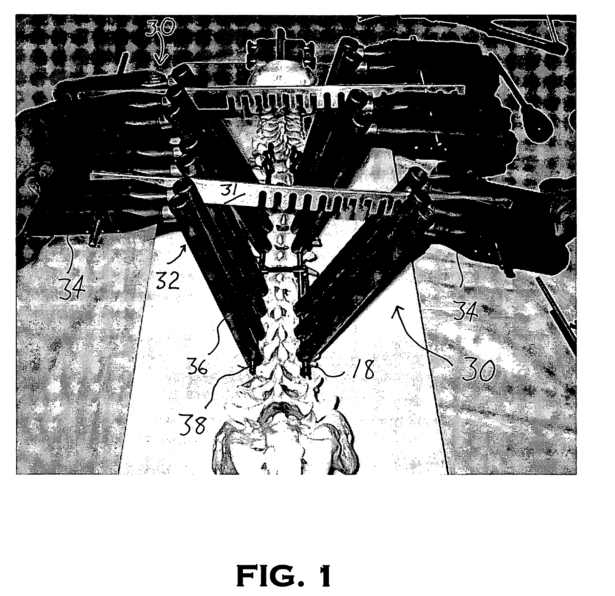 System and method for aligning vertebrae in the amelioration of aberrant spinal column deviation conditions