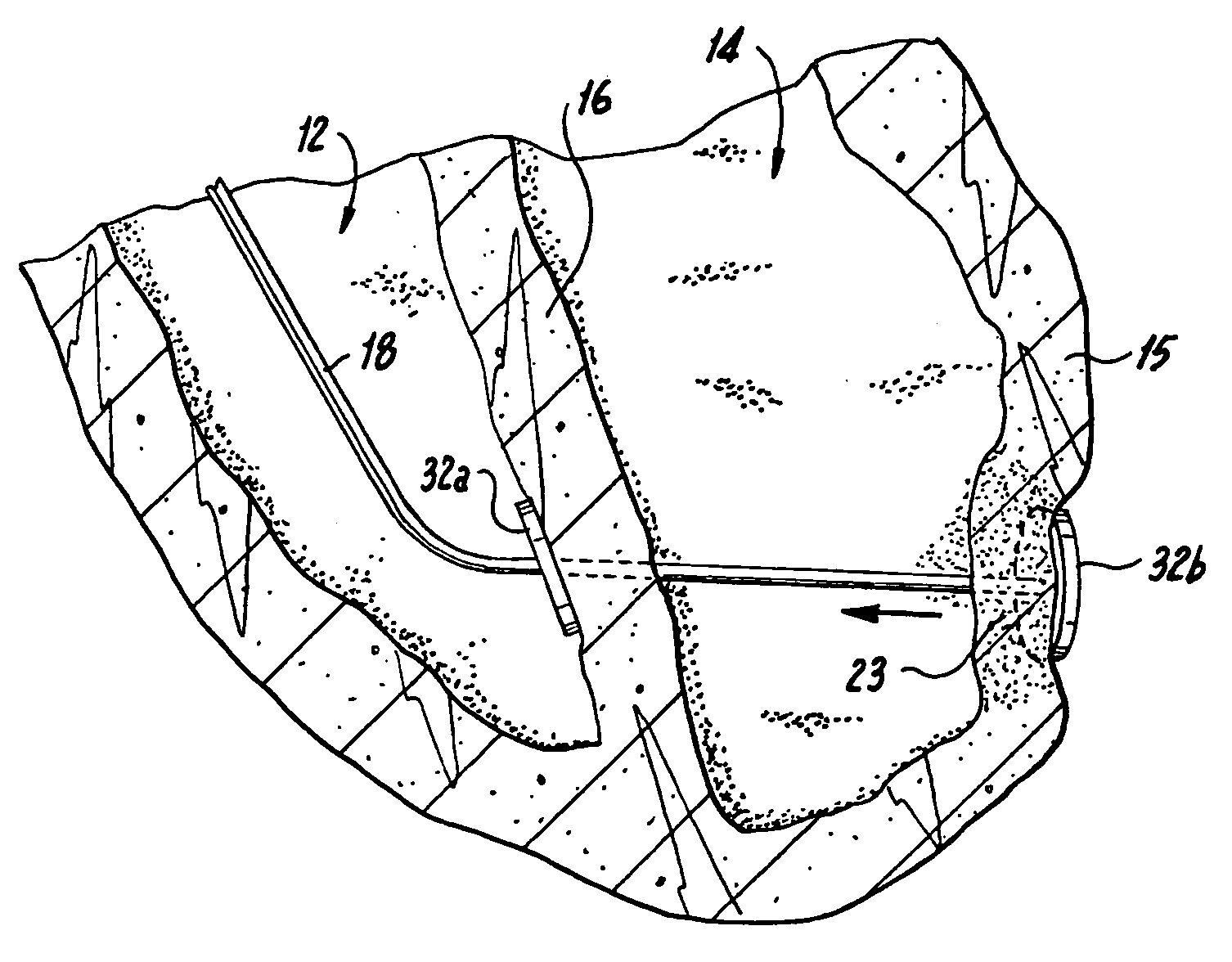 Method and device for percutaneous left ventricular reconstruction