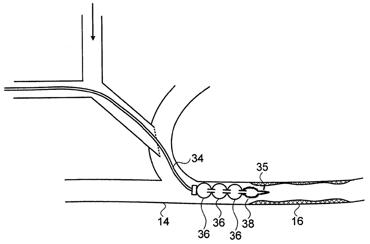 Device for prevention of shunt stenosis