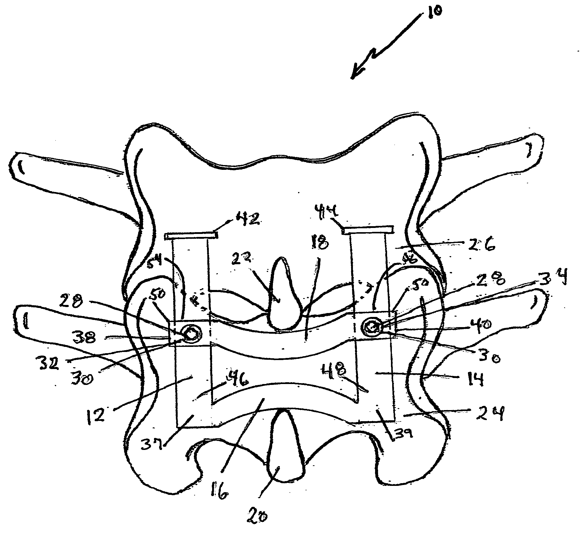 Adjustable spinous process spacer device and method of treating spinal stenosis
