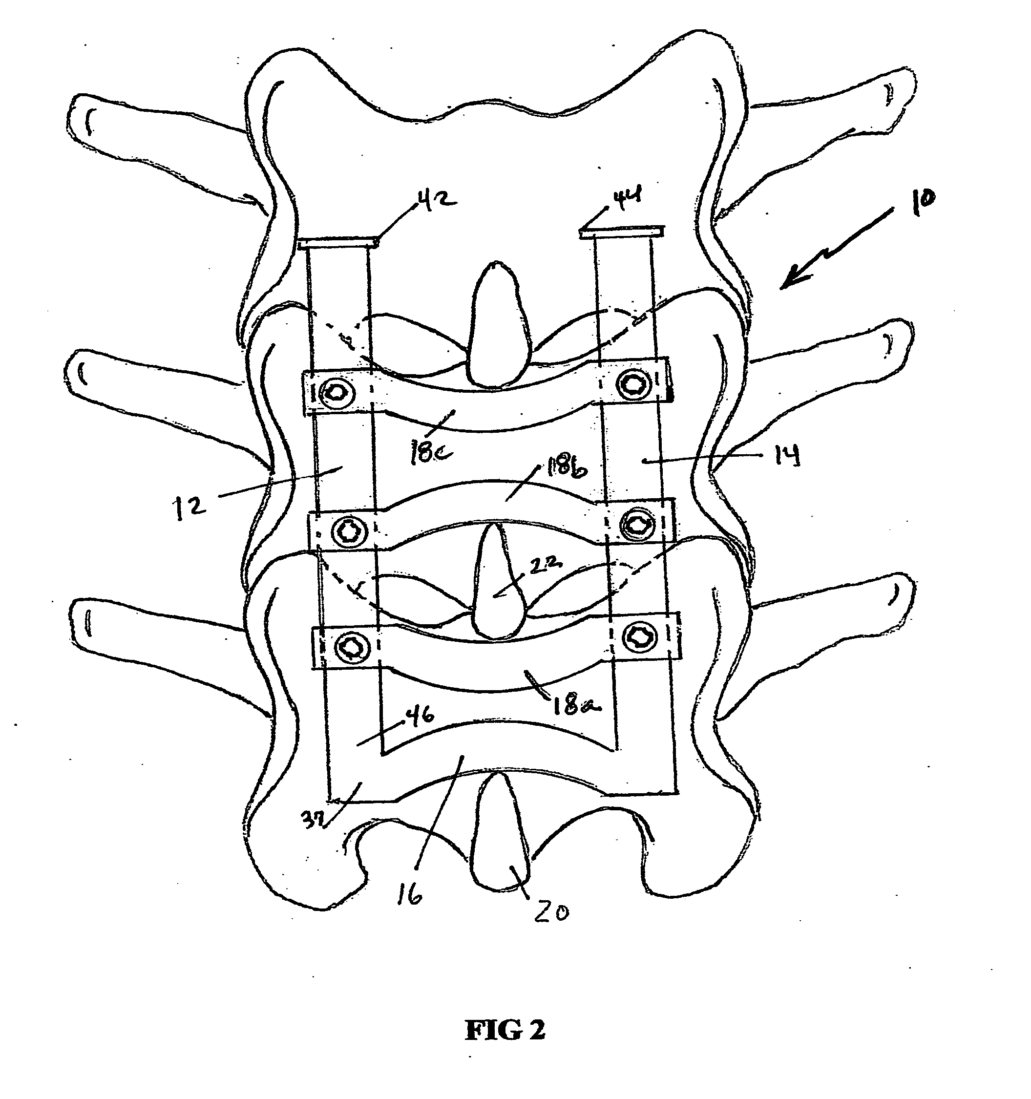 Adjustable spinous process spacer device and method of treating spinal stenosis