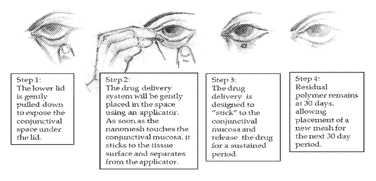 Methods and biocompatible compositions to achieve sustained drug release in the eye