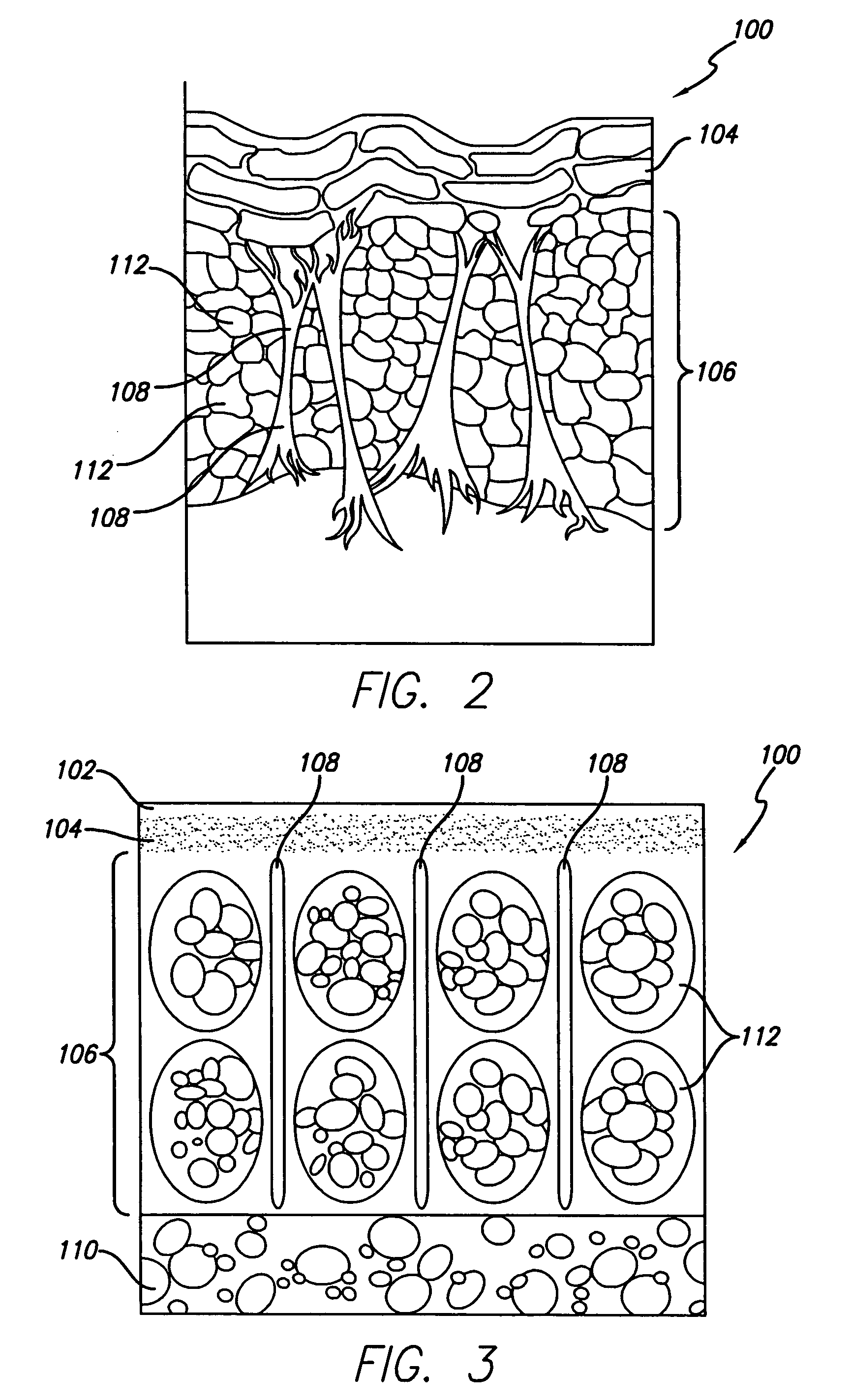 Methods and system for treating subcutaneous tissues