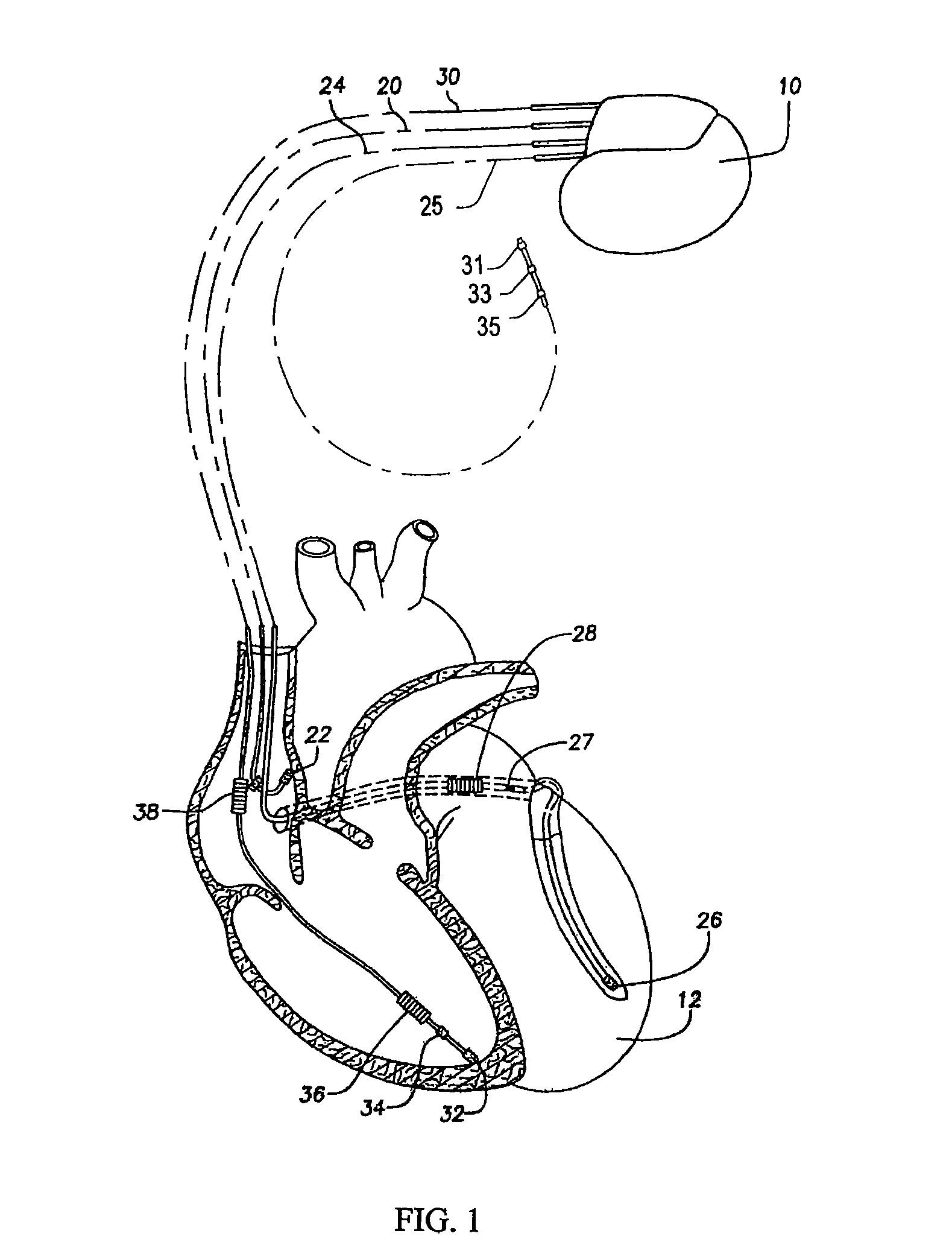 Methods and devices for monitoring myocardial electro-mechanical stability