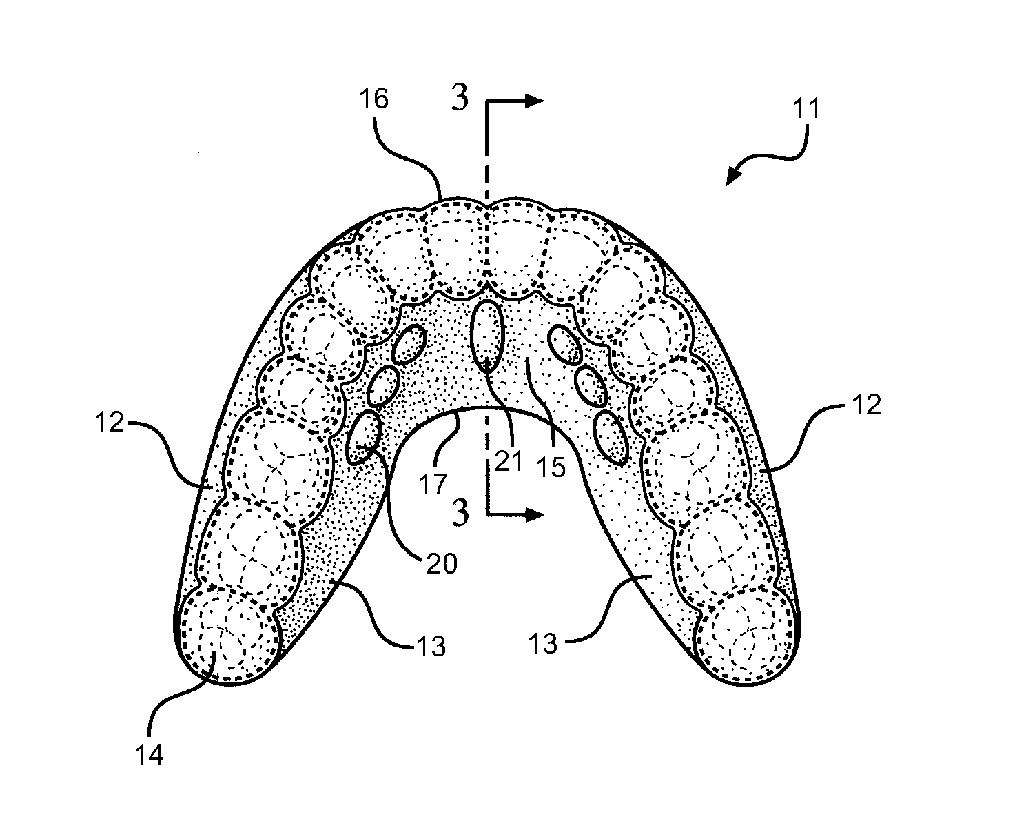 Method and Oral Appliance for Improving Air Intake and Reducing Bruxism