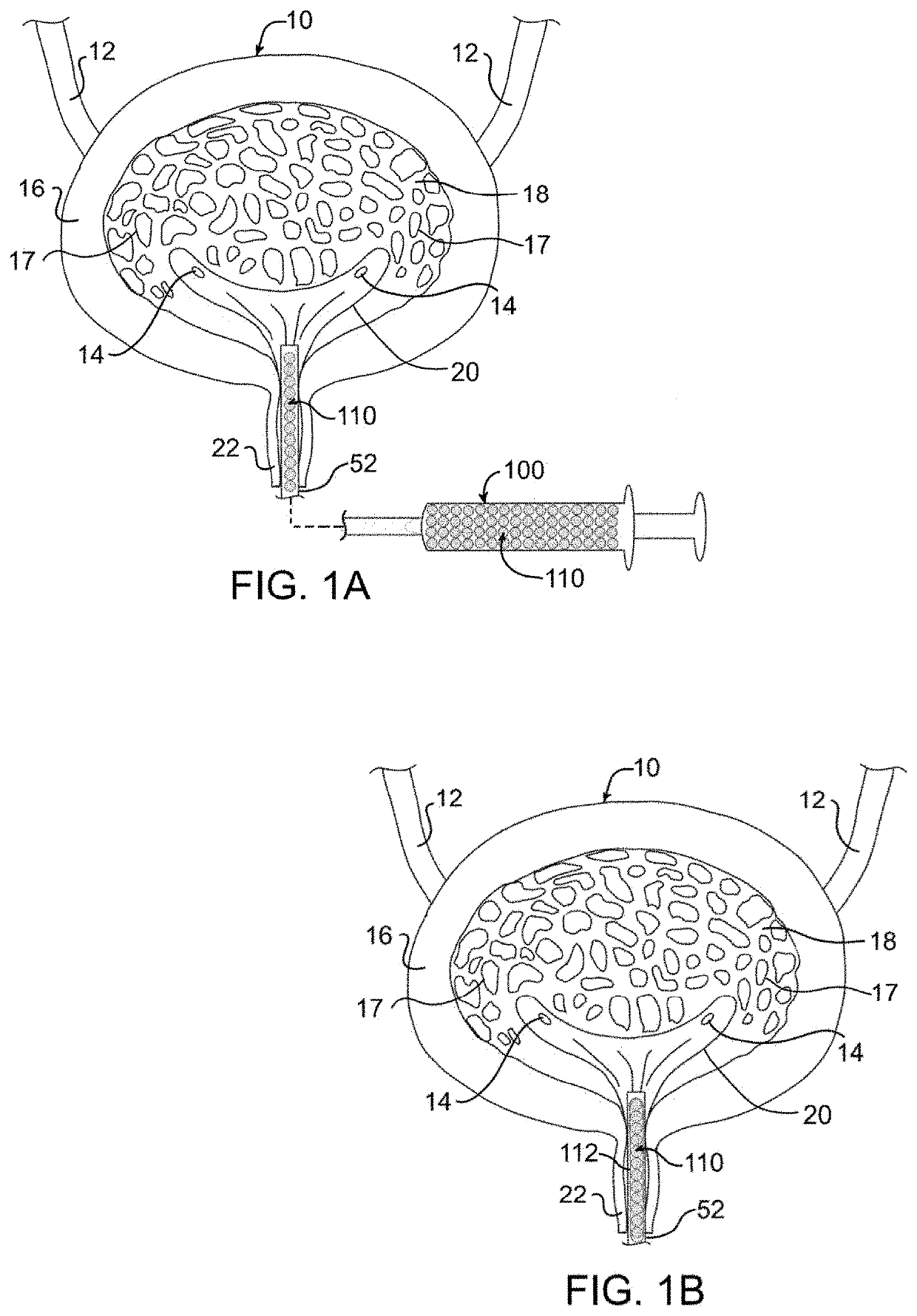 Device and method for improving retention of a therapy in the bladder