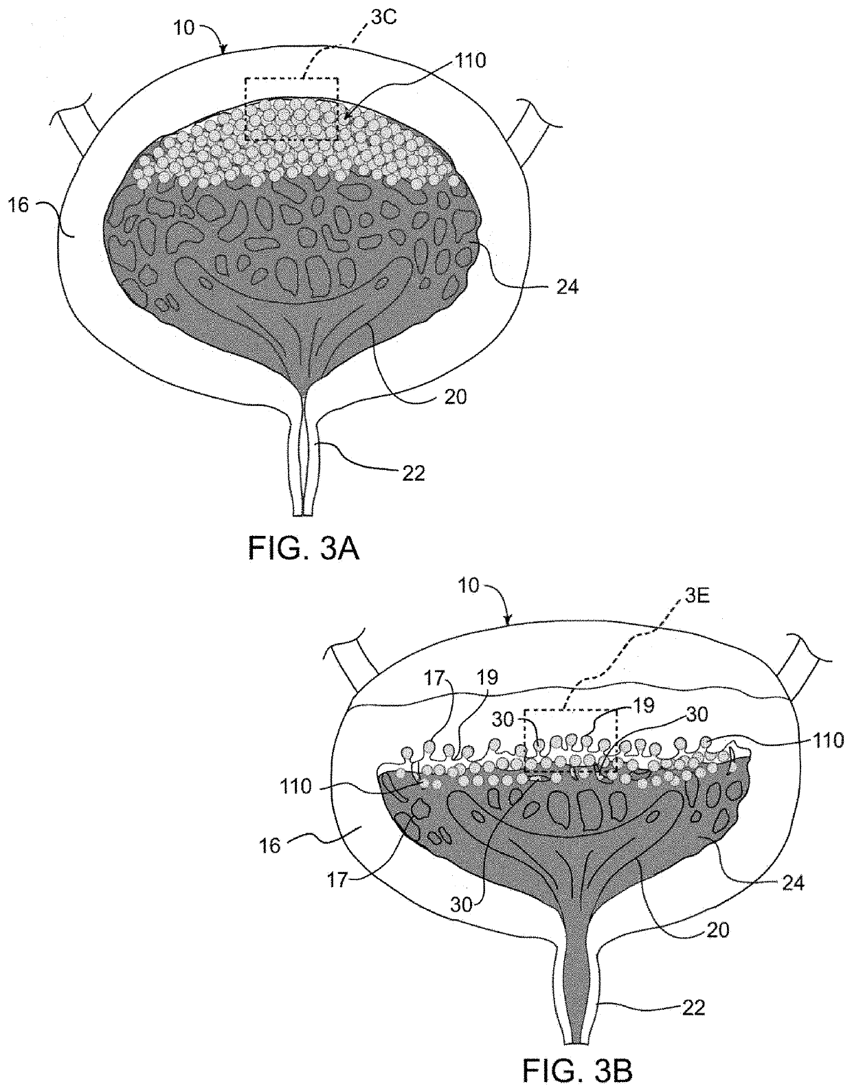 Device and method for improving retention of a therapy in the bladder