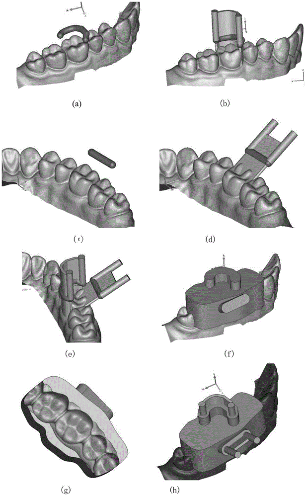 Digital oral fixed restoration method and device