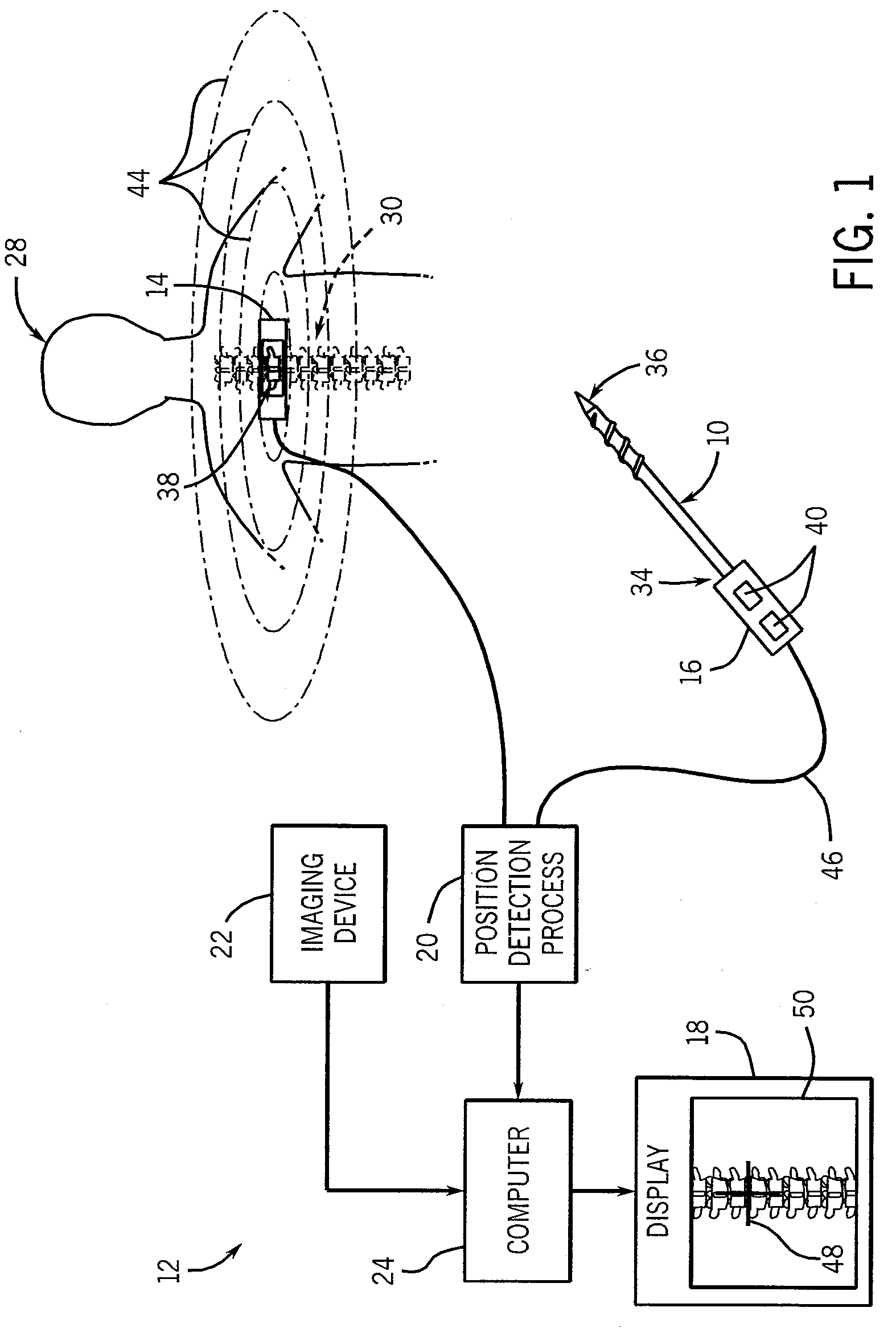 Method and apparatus for performing pedicle screw fusion surgery