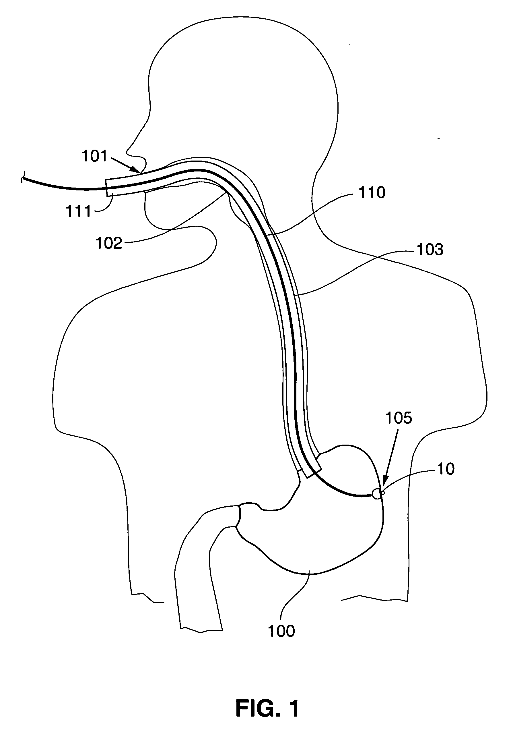Gastrointestinal anchor with optimal surface area