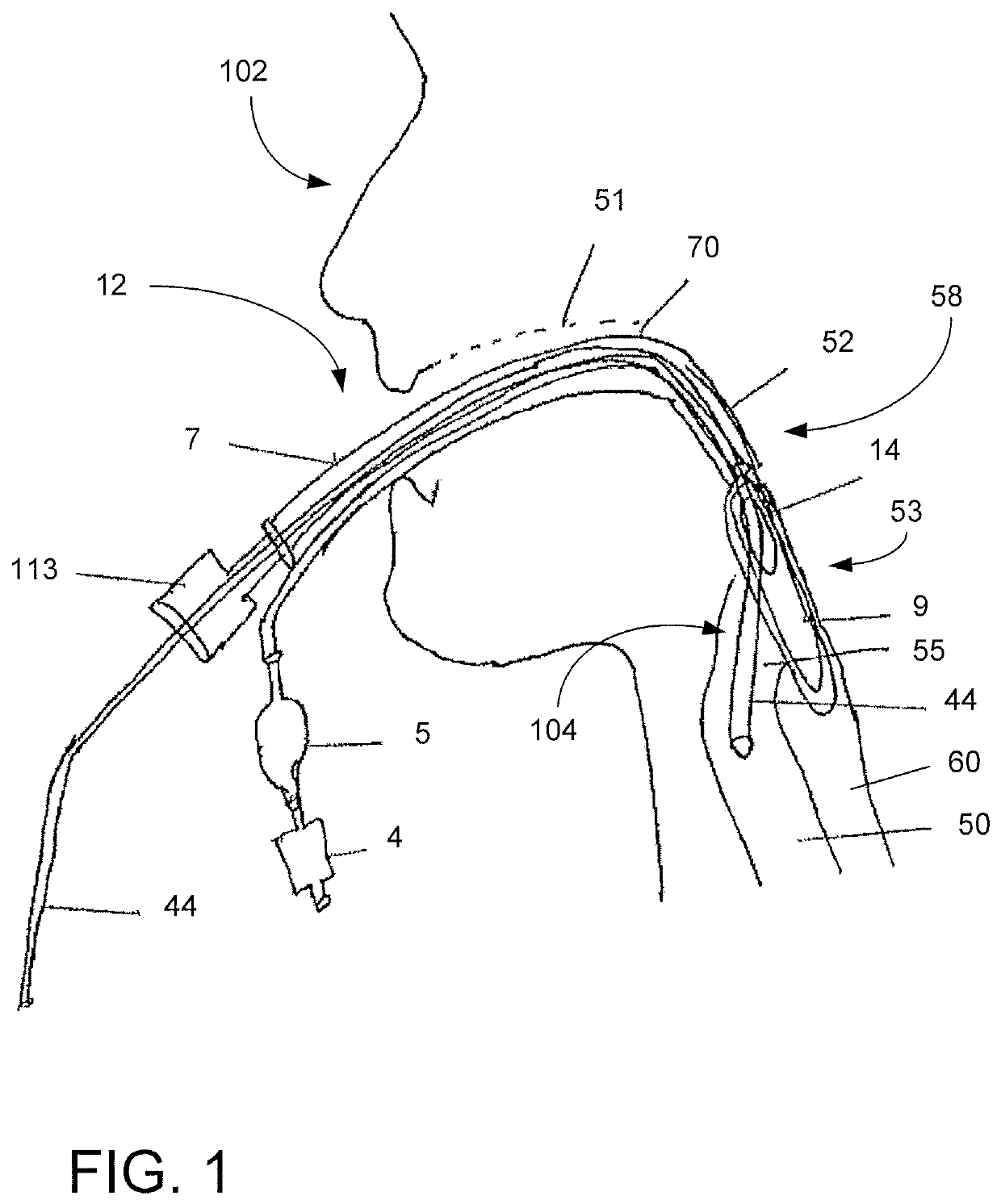 Neonatal laryngeal mask airway