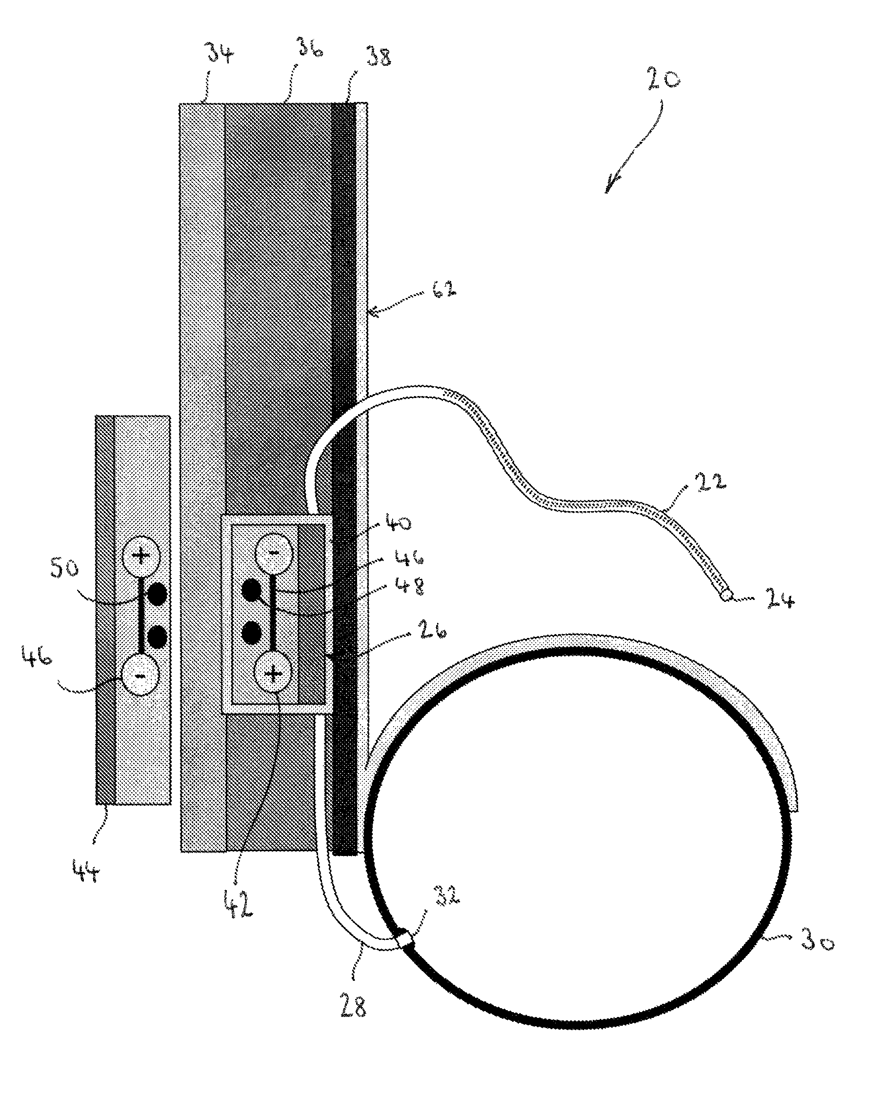 Implantable fluid management device for the removal of excess fluid