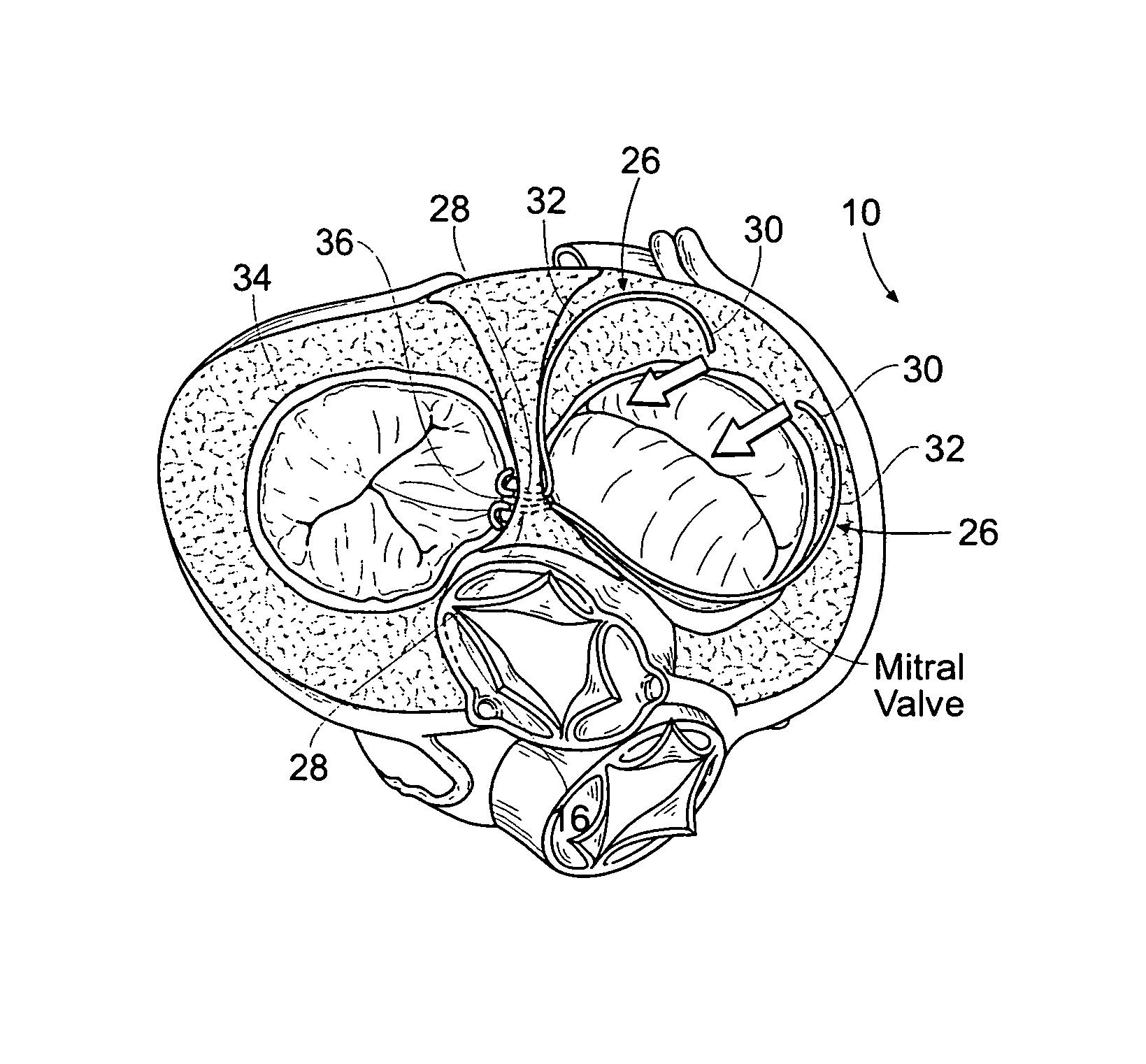 Method of reshaping a heart valve annulus using an intravascular device