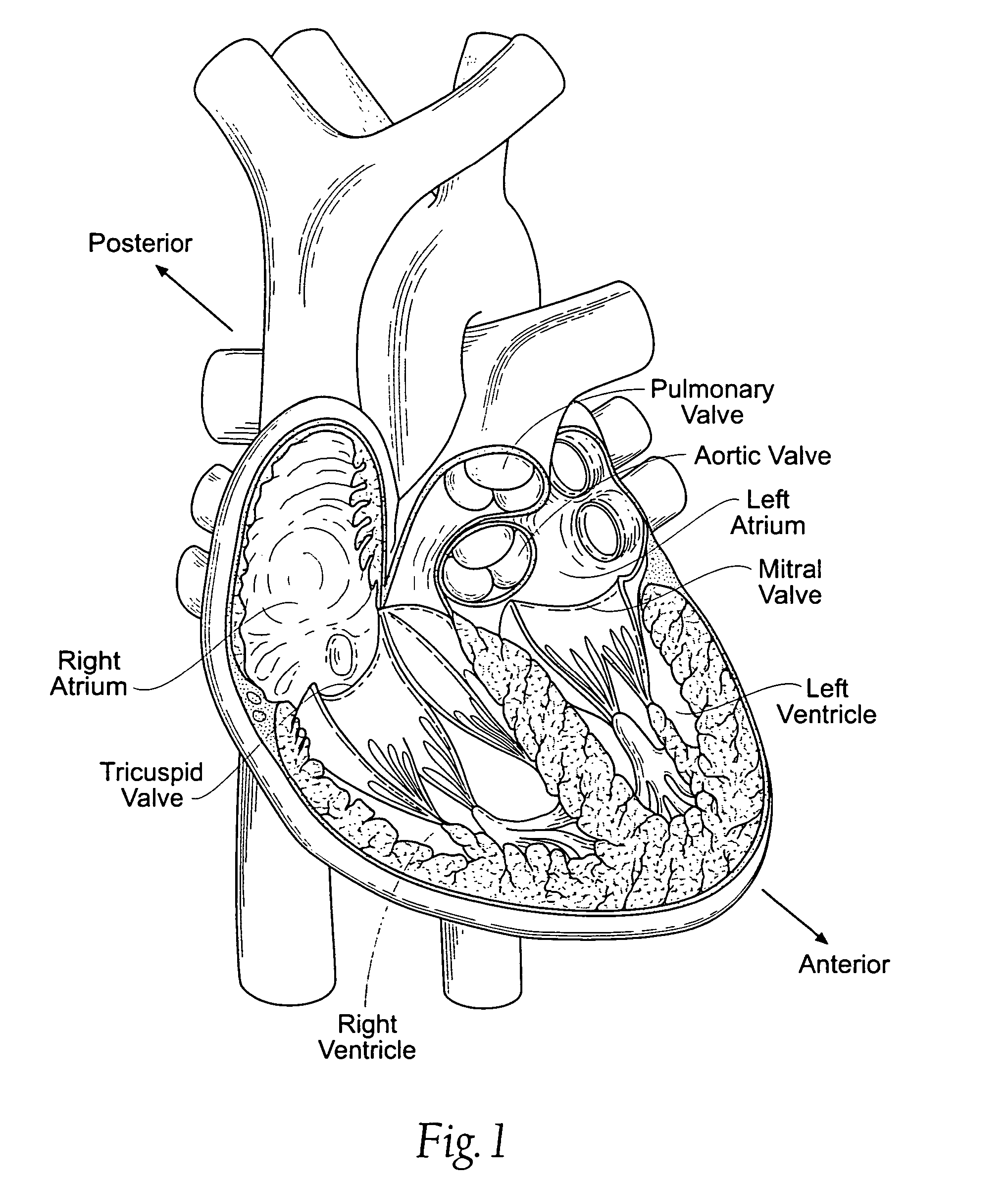 Method of reshaping a heart valve annulus using an intravascular device