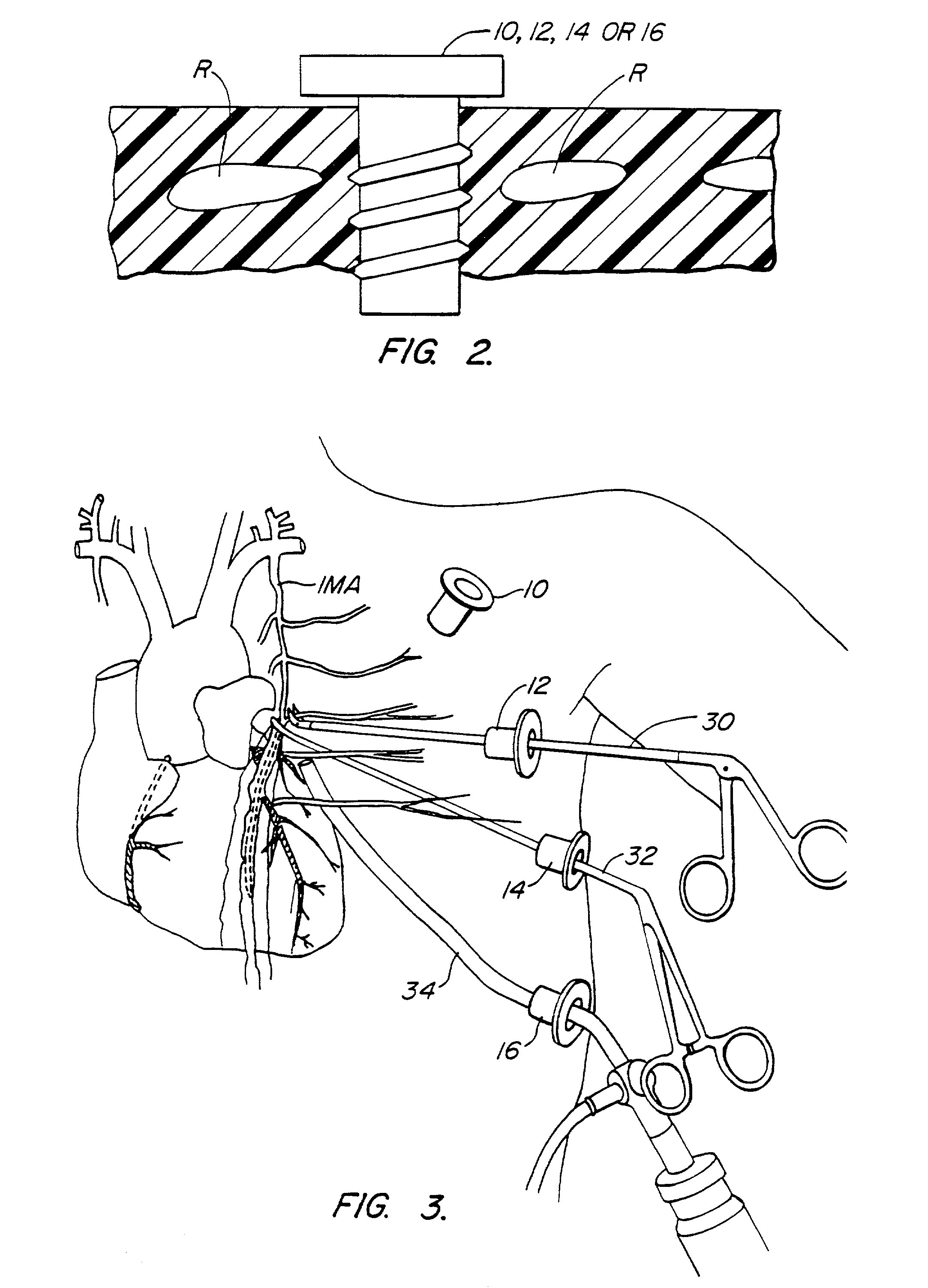 Methods and systems for performing thoracoscopic coronary bypass and other procedures