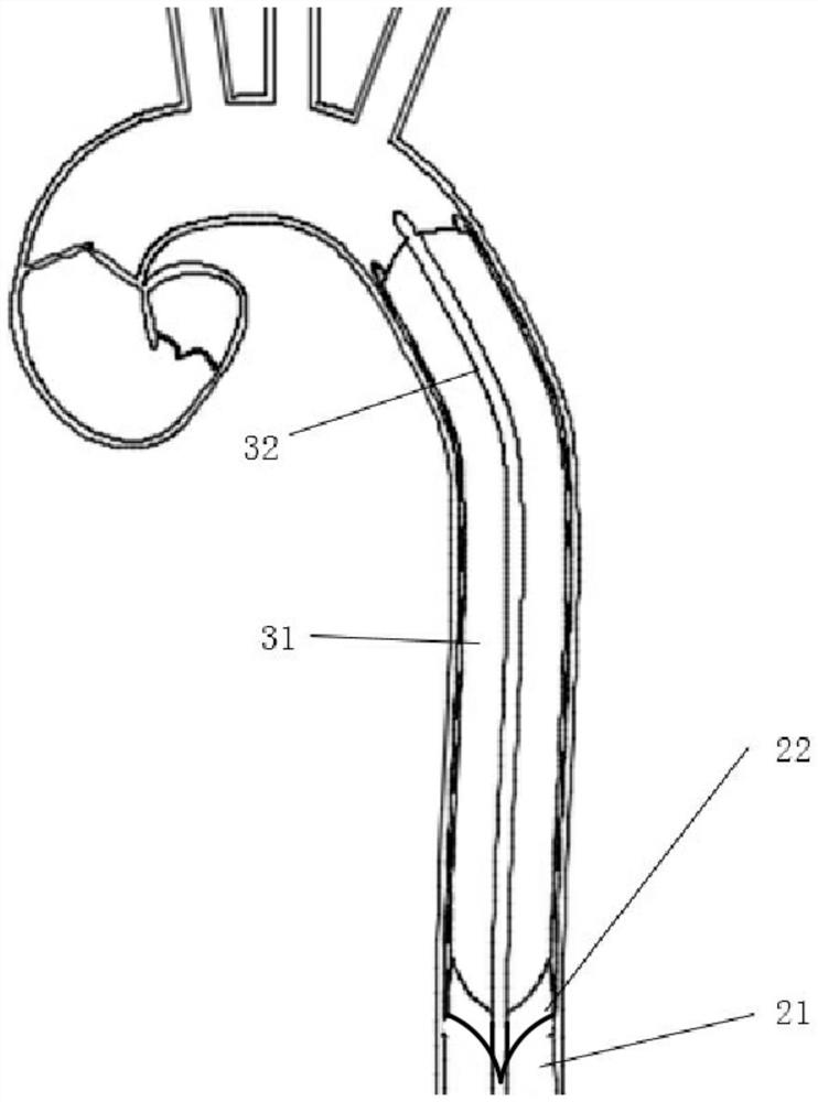 Intra-aortic balloon counterpulsation synergistic device with valve covered stent and using method
