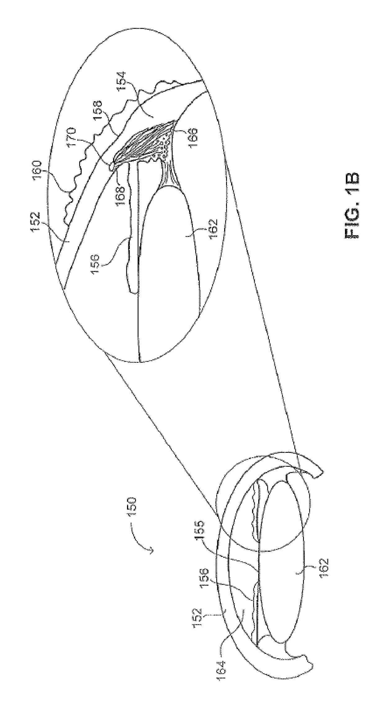 Ocular implant with intraocular fluid pressure regulation