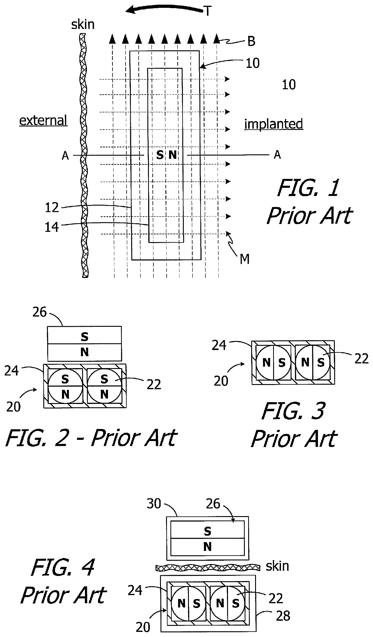Cochlear implants having MRI-compatible magnet apparatus