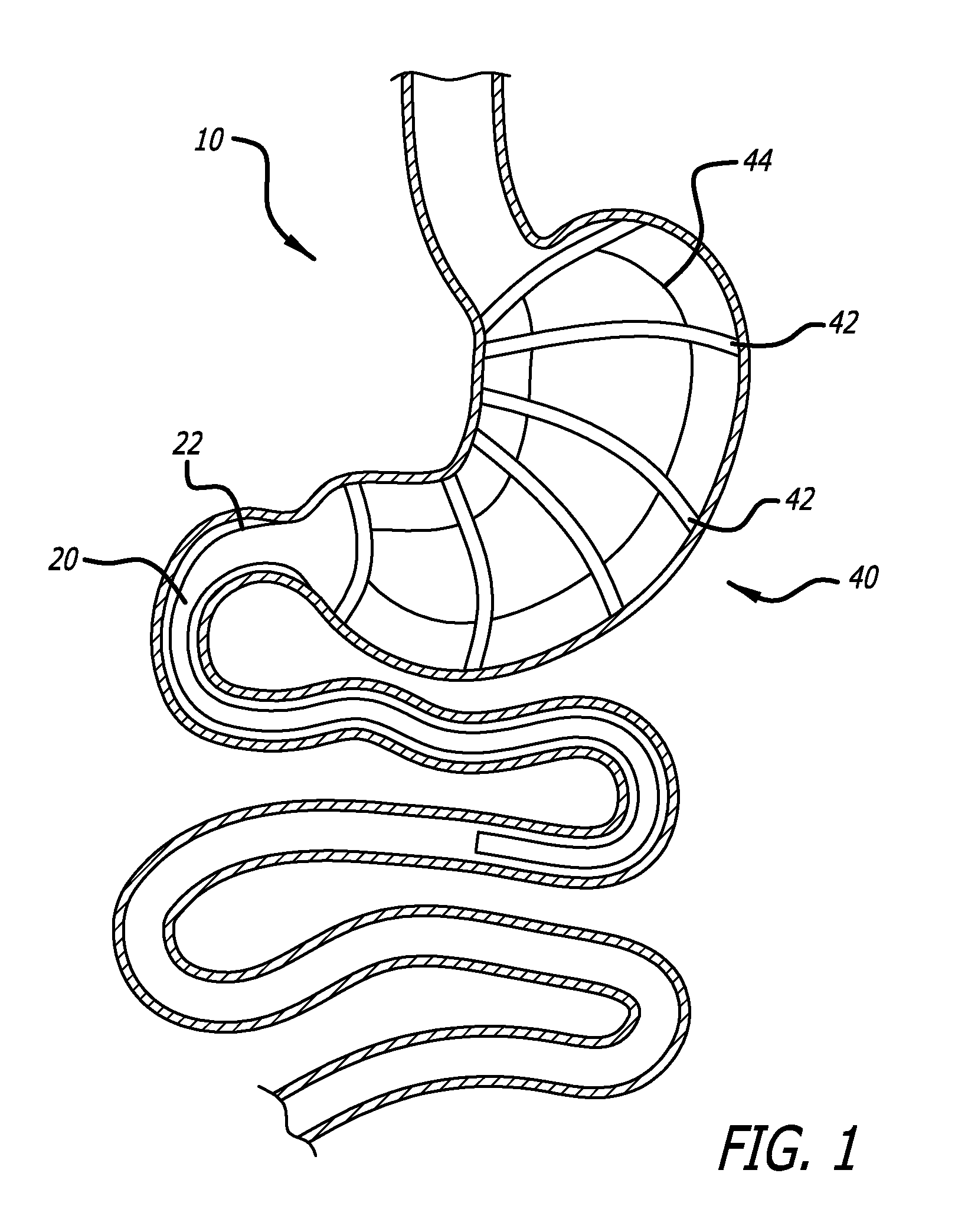 Methods And Devices For Anchoring A Gastroenterologic Sleeve
