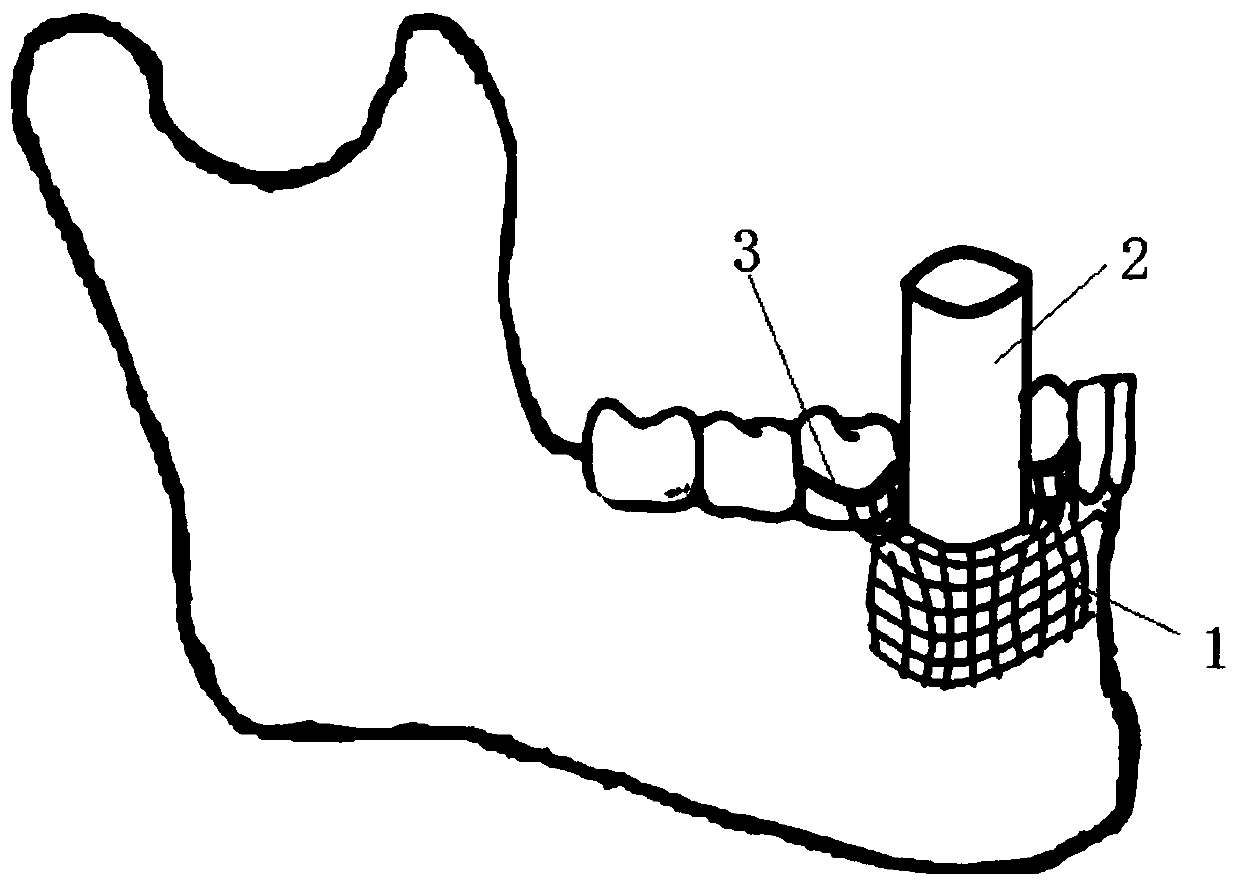 Titanium mesh device with individualized bone ridge regeneration titanium mesh, for accurate implant tooth repairing operation and manufacturing method of titanium mesh device