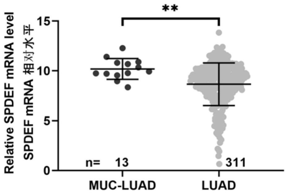 Application of SPDEF gene inhibitor in preparation of medicine for enhancing sensitivity of lung mucus adenocarcinoma cells to cis-platinum