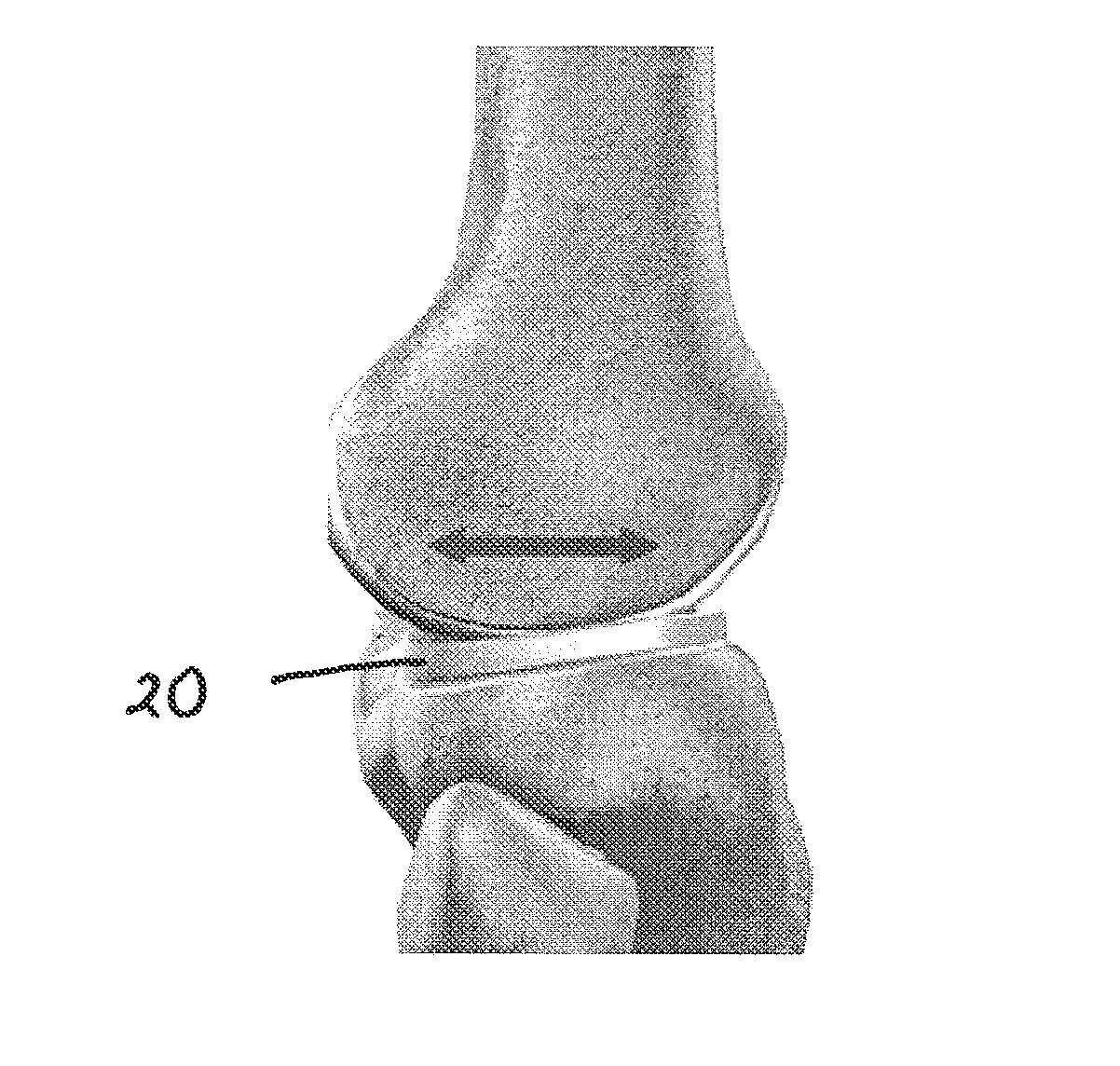 Low friction resurfacing implant