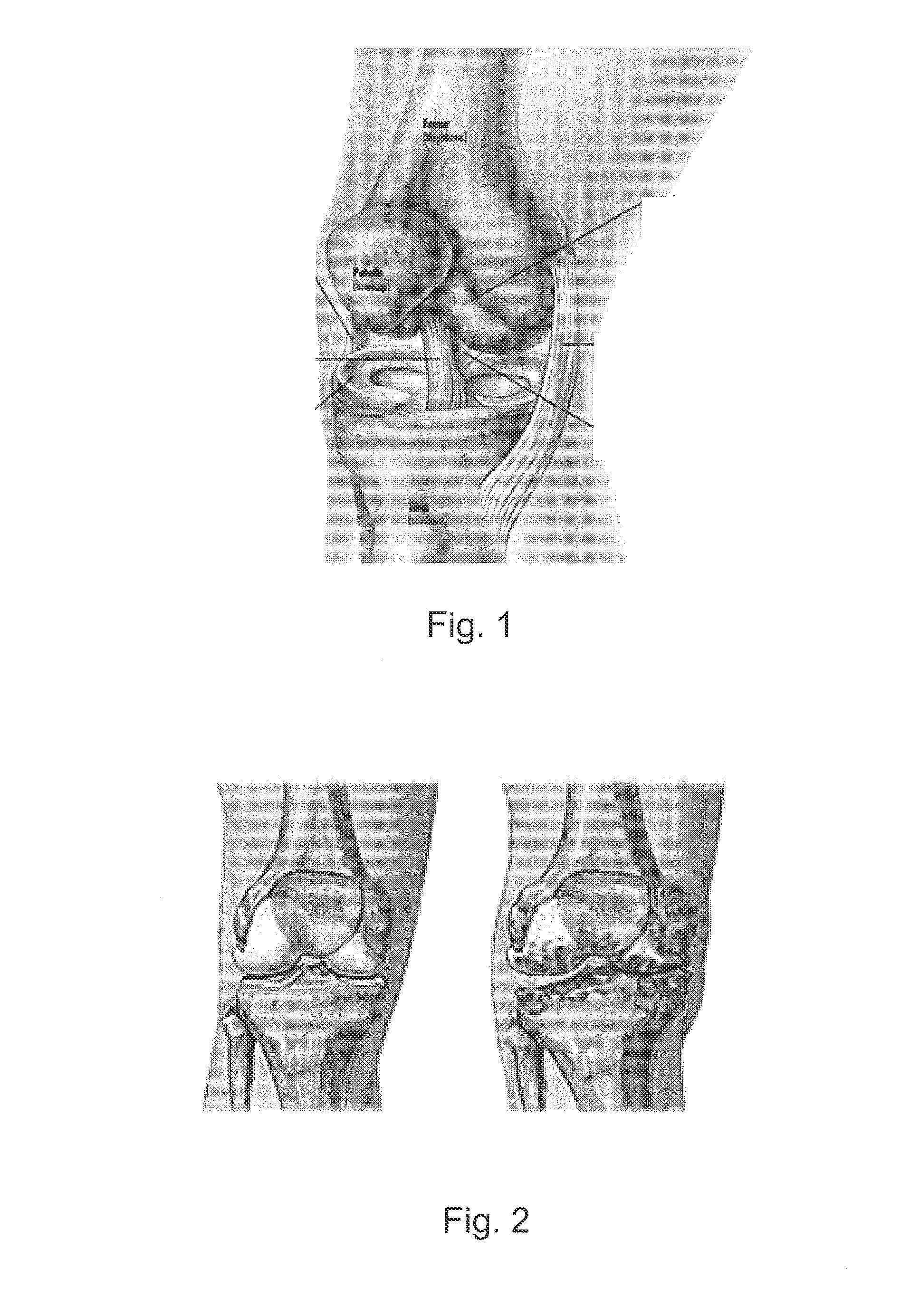 Low friction resurfacing implant