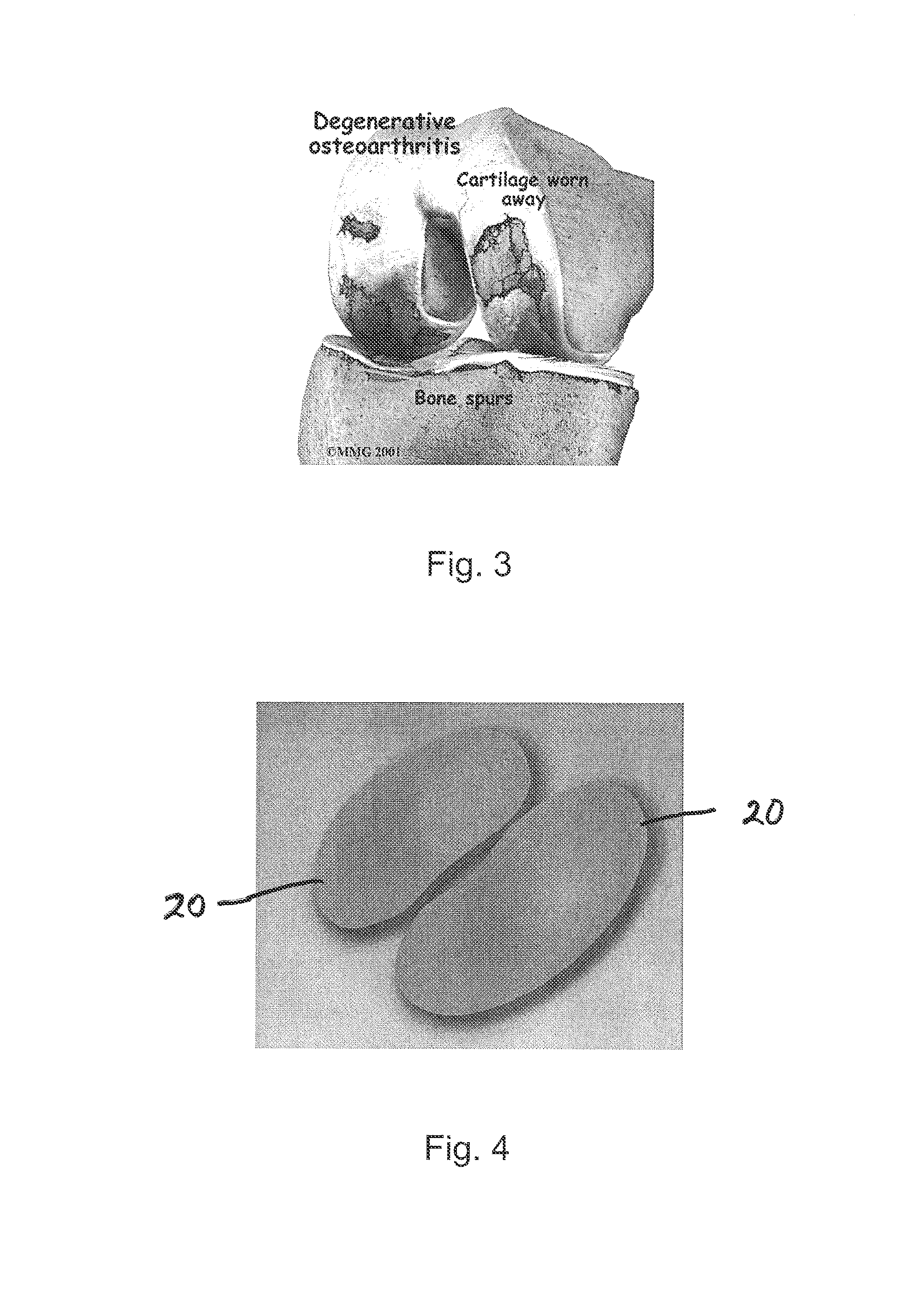 Low friction resurfacing implant
