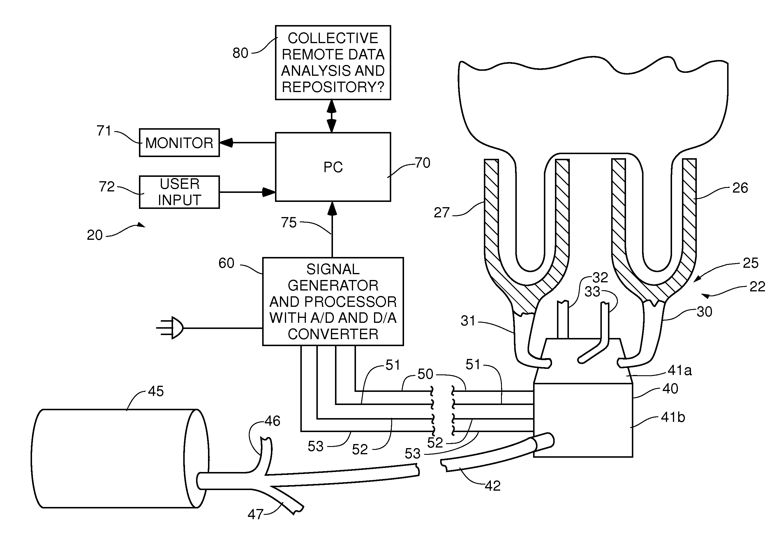 System and method of sub clinical detecting mastitis