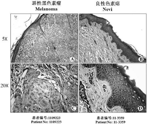 Construction method and application of human miR-106b-5p interference fragment