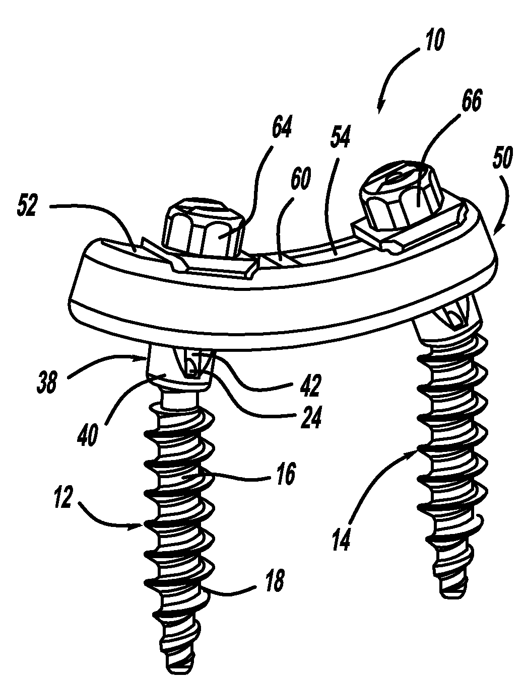 Pedicle Screw and Rod System
