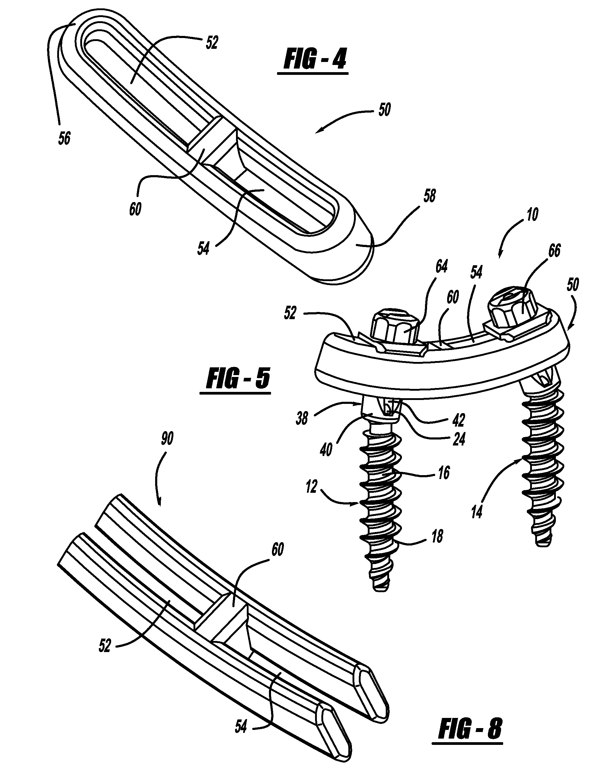 Pedicle Screw and Rod System