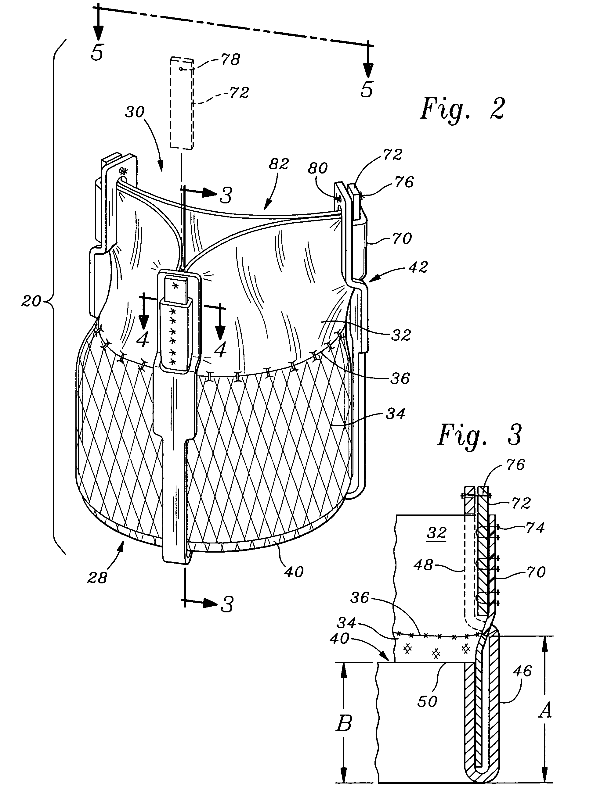 System and method for implanting a two-part prosthetic heart valve
