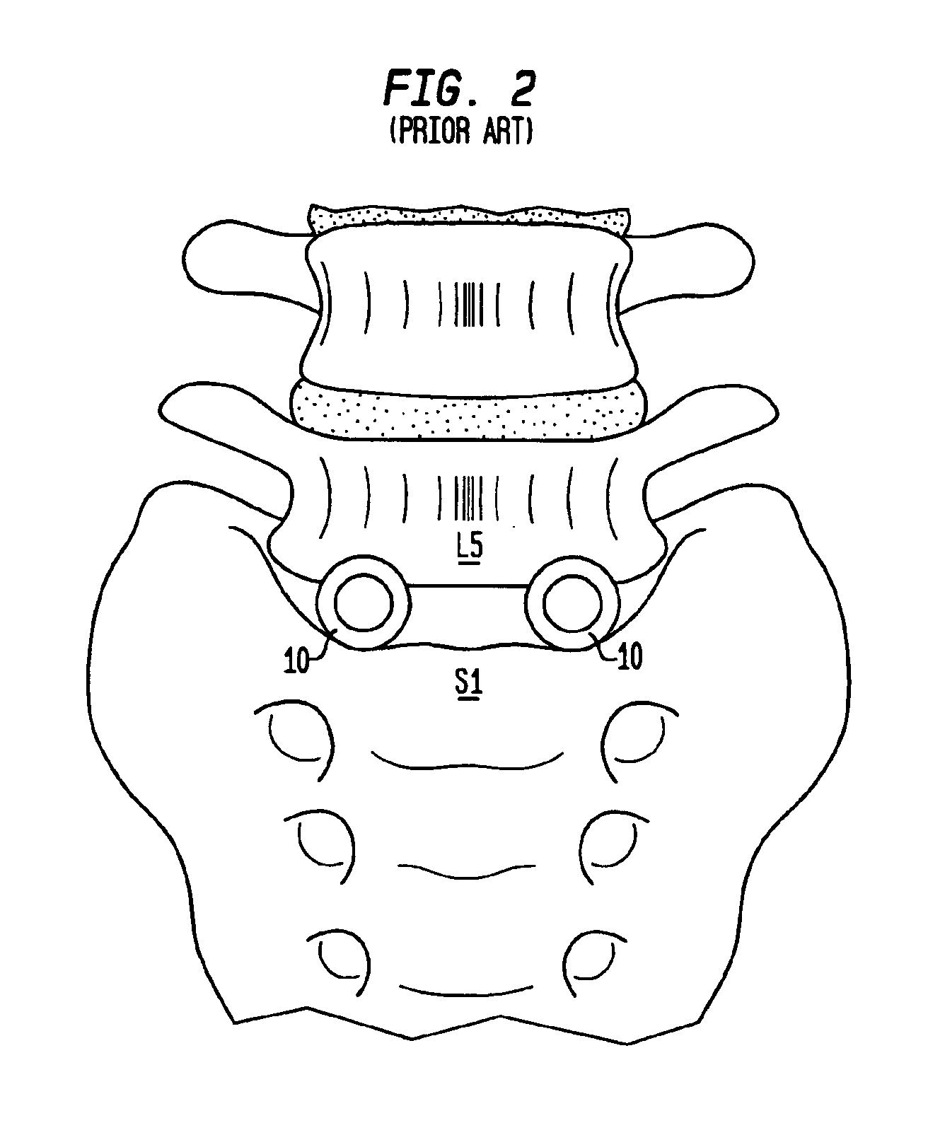 Intervertebral spacer device having a domed arch shaped spring