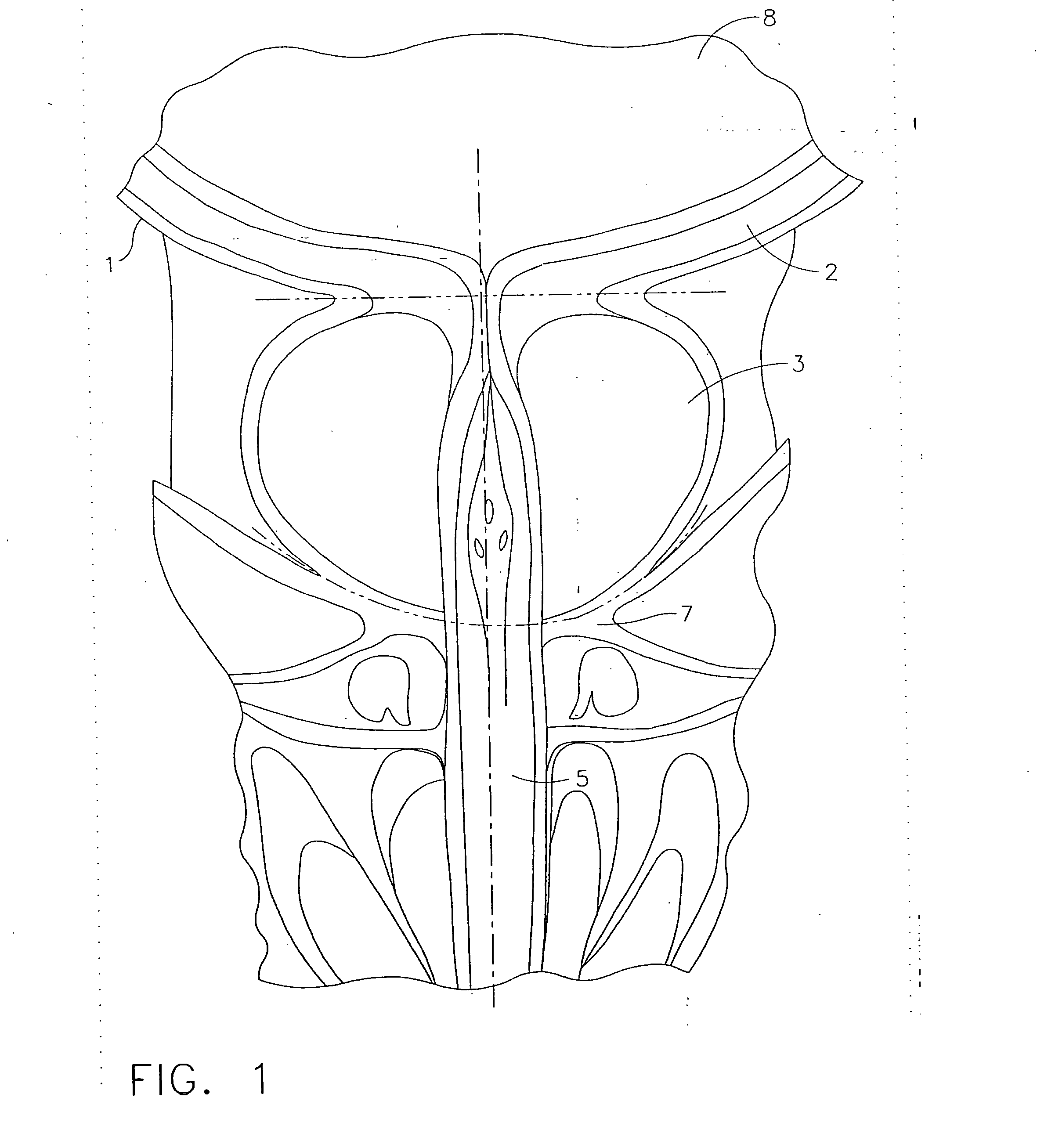 Anchors for use in attachment of bladder tissues to pelvic floor tissues following a prostatectomy