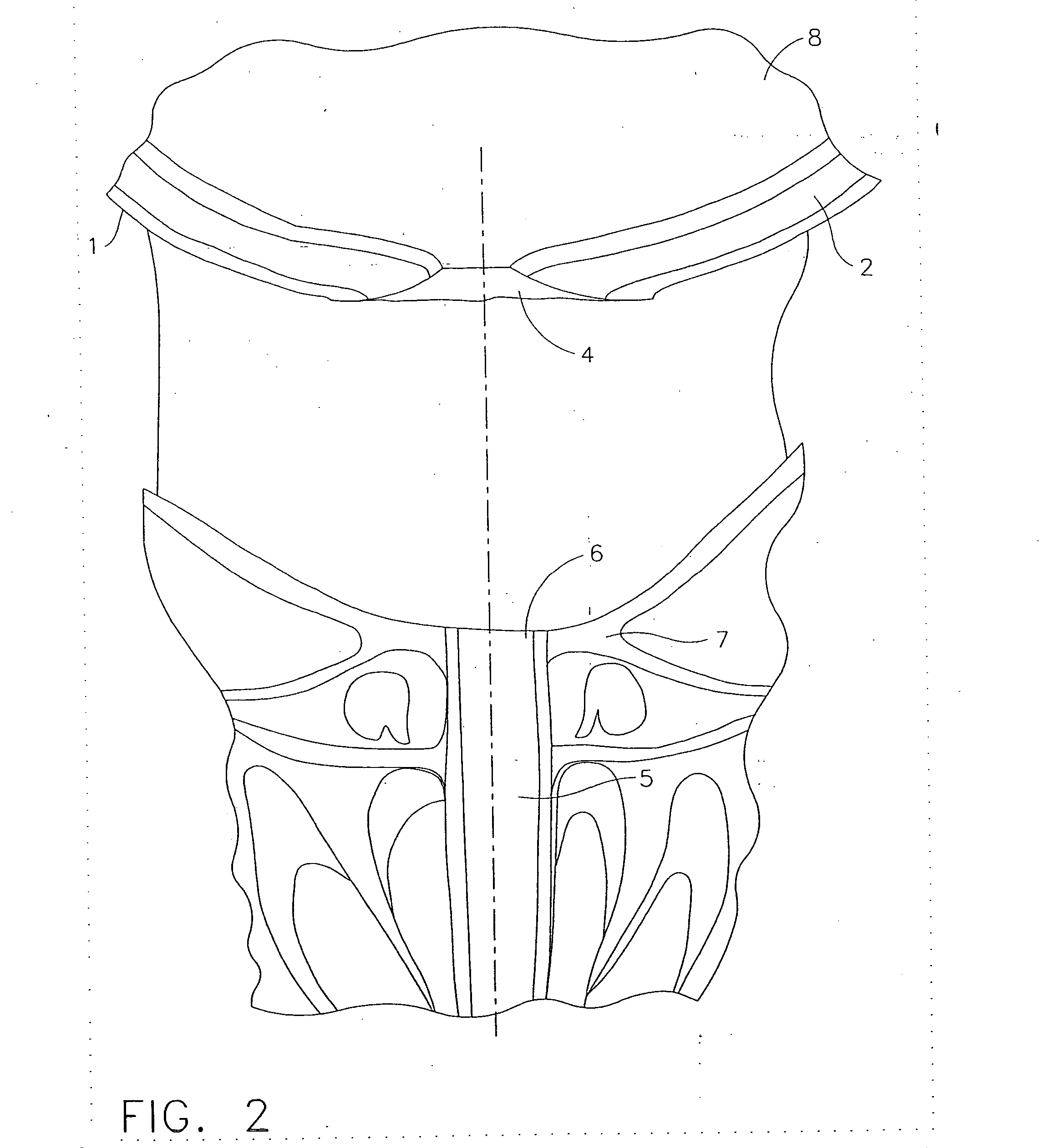 Anchors for use in attachment of bladder tissues to pelvic floor tissues following a prostatectomy