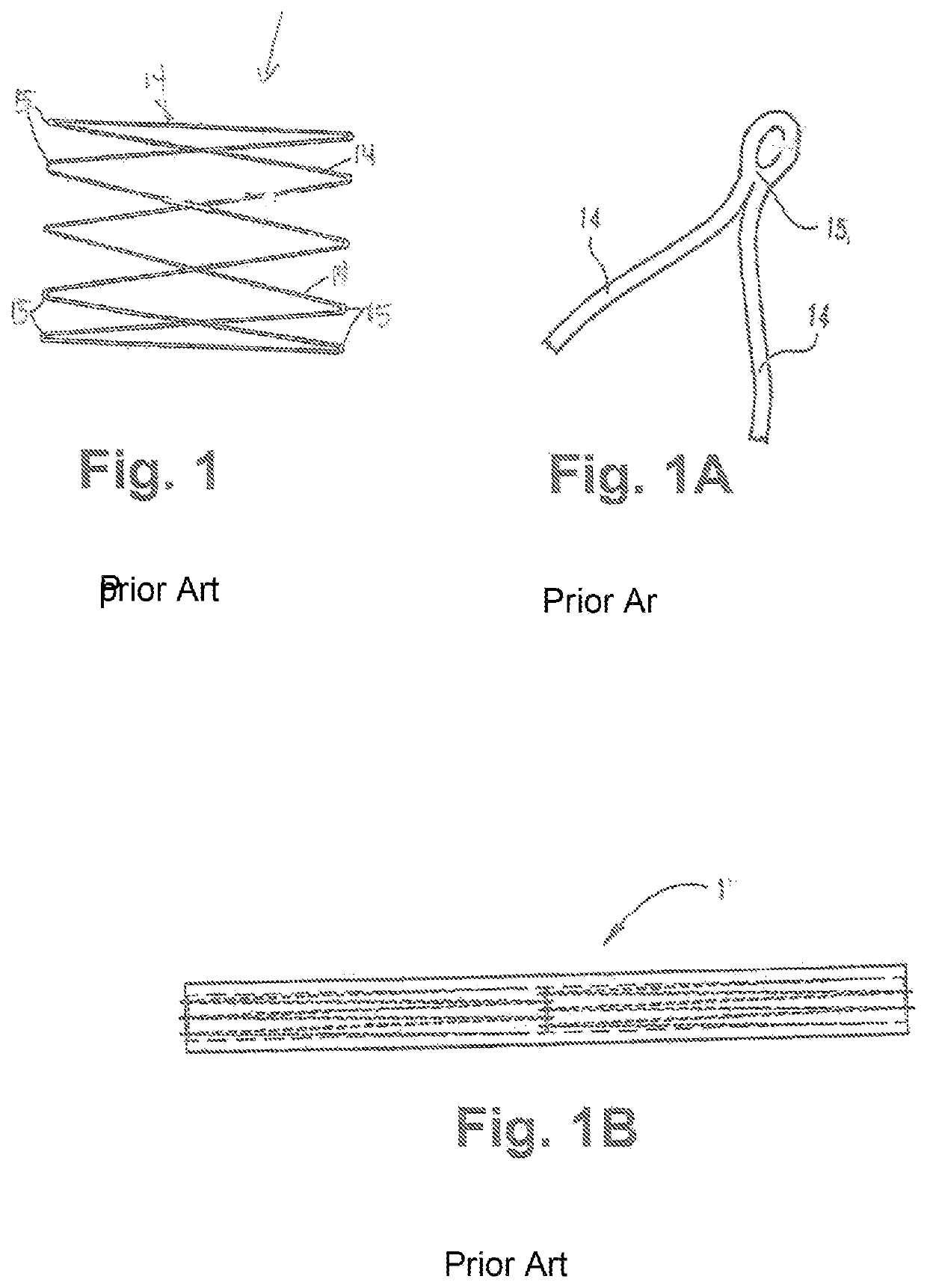 Modified Z Stents for Iliac Vein Stenting