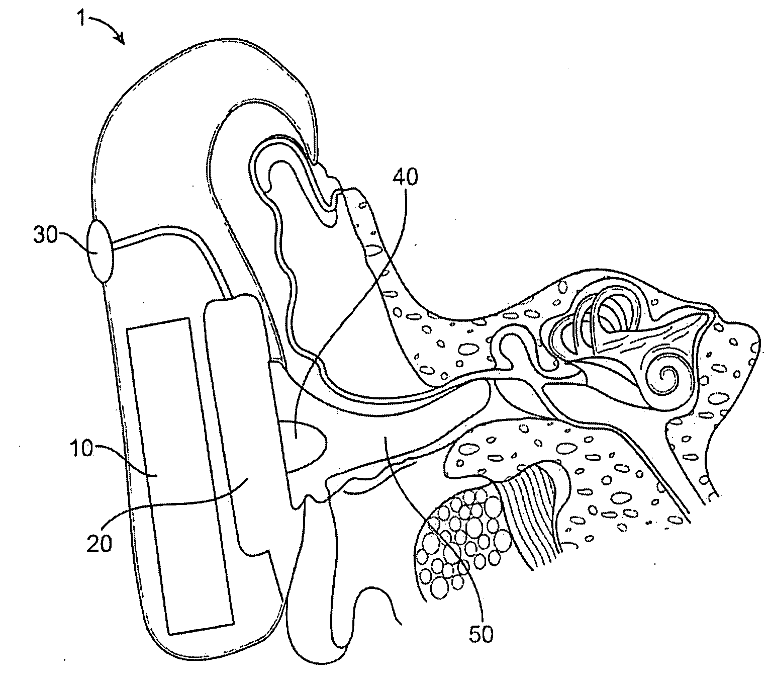 Optical ear infection treatment device and method