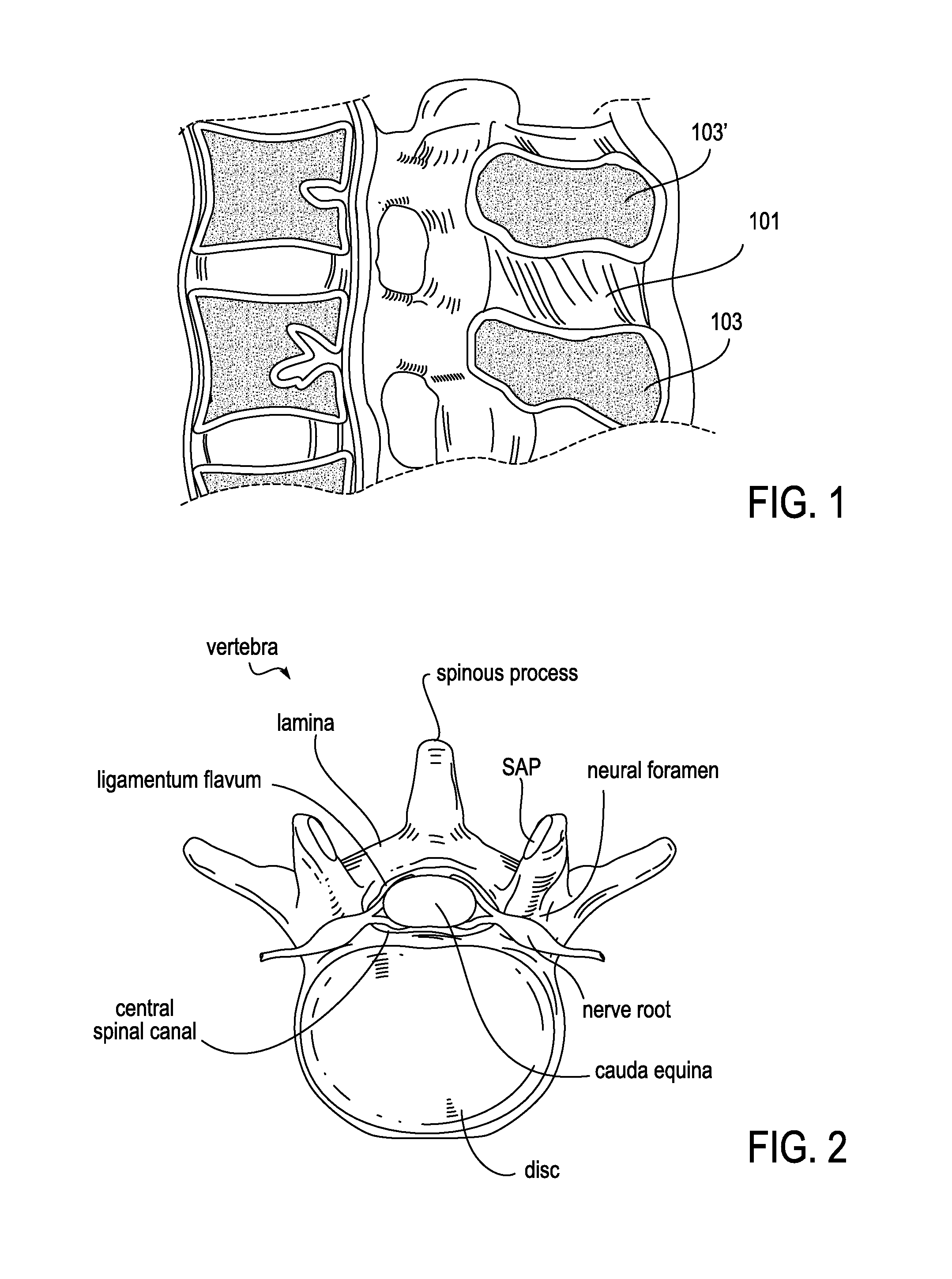 Systems and methods for performing spinal fusion