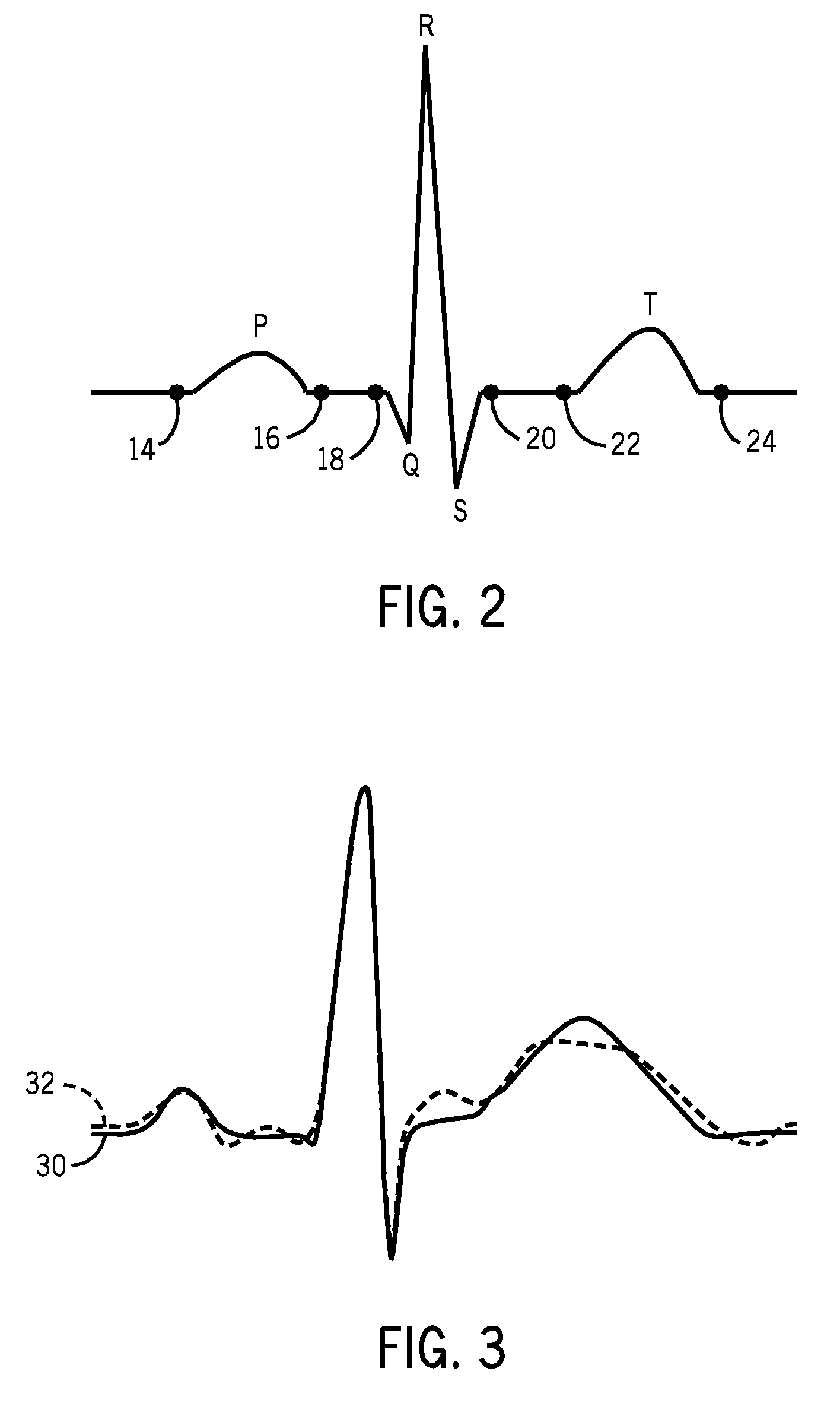 Method and system for detecting T-wave alternans