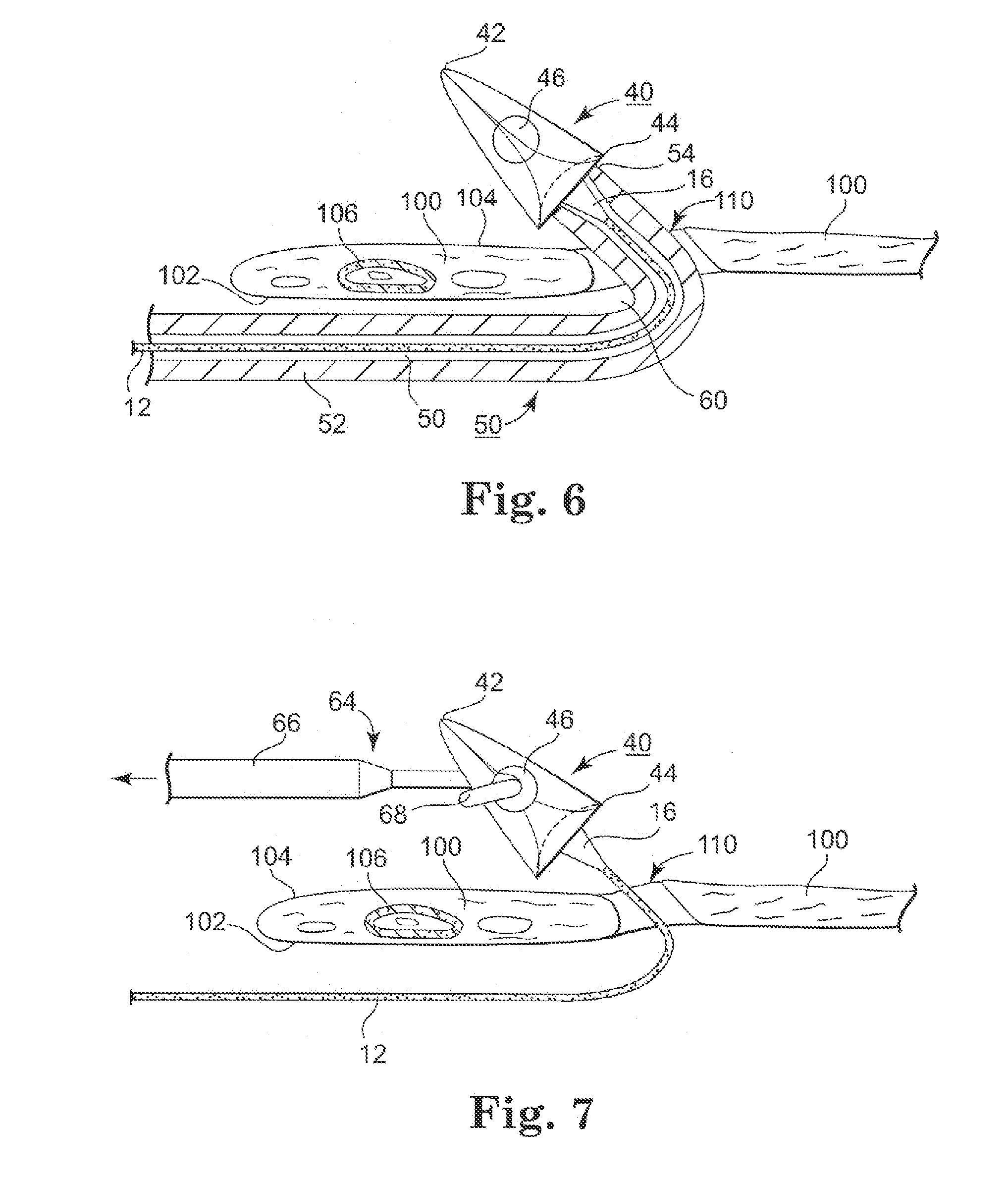 Minimally Invasive Methods and Apparatus for Accessing and Ligating Uterine Arteries with Sutures