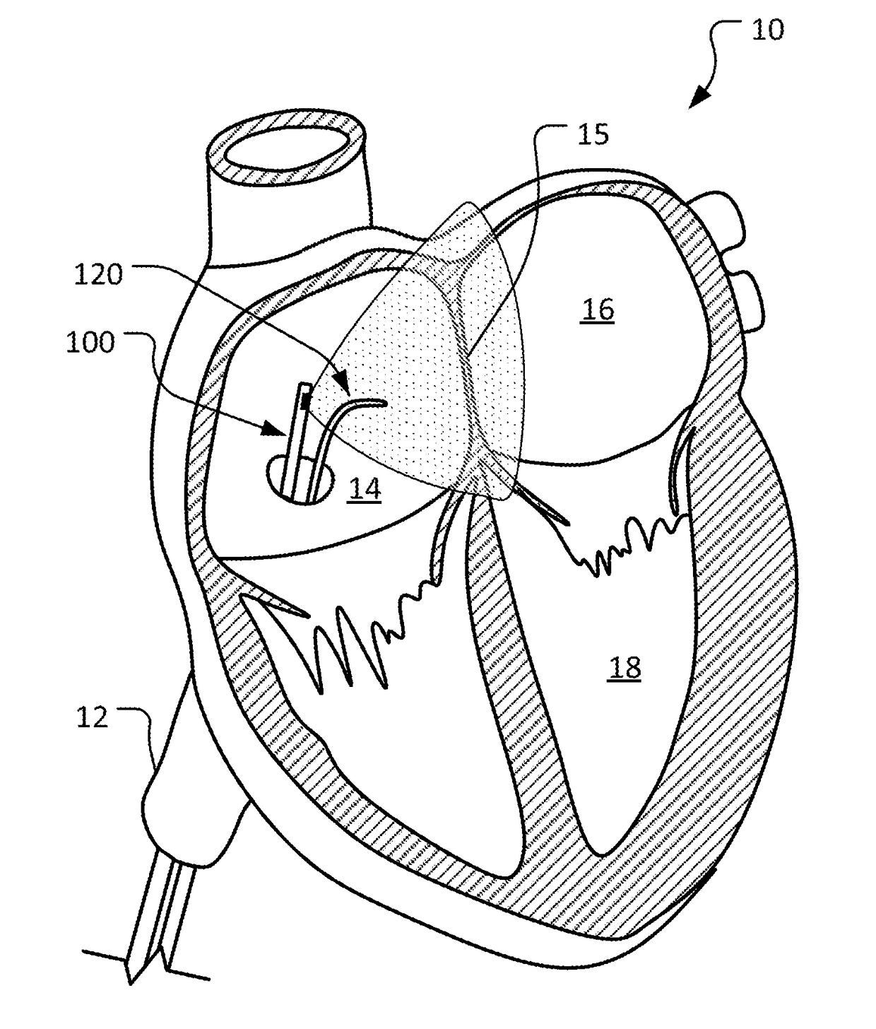 Intra-cardiac echocardiography with magnetic coupling