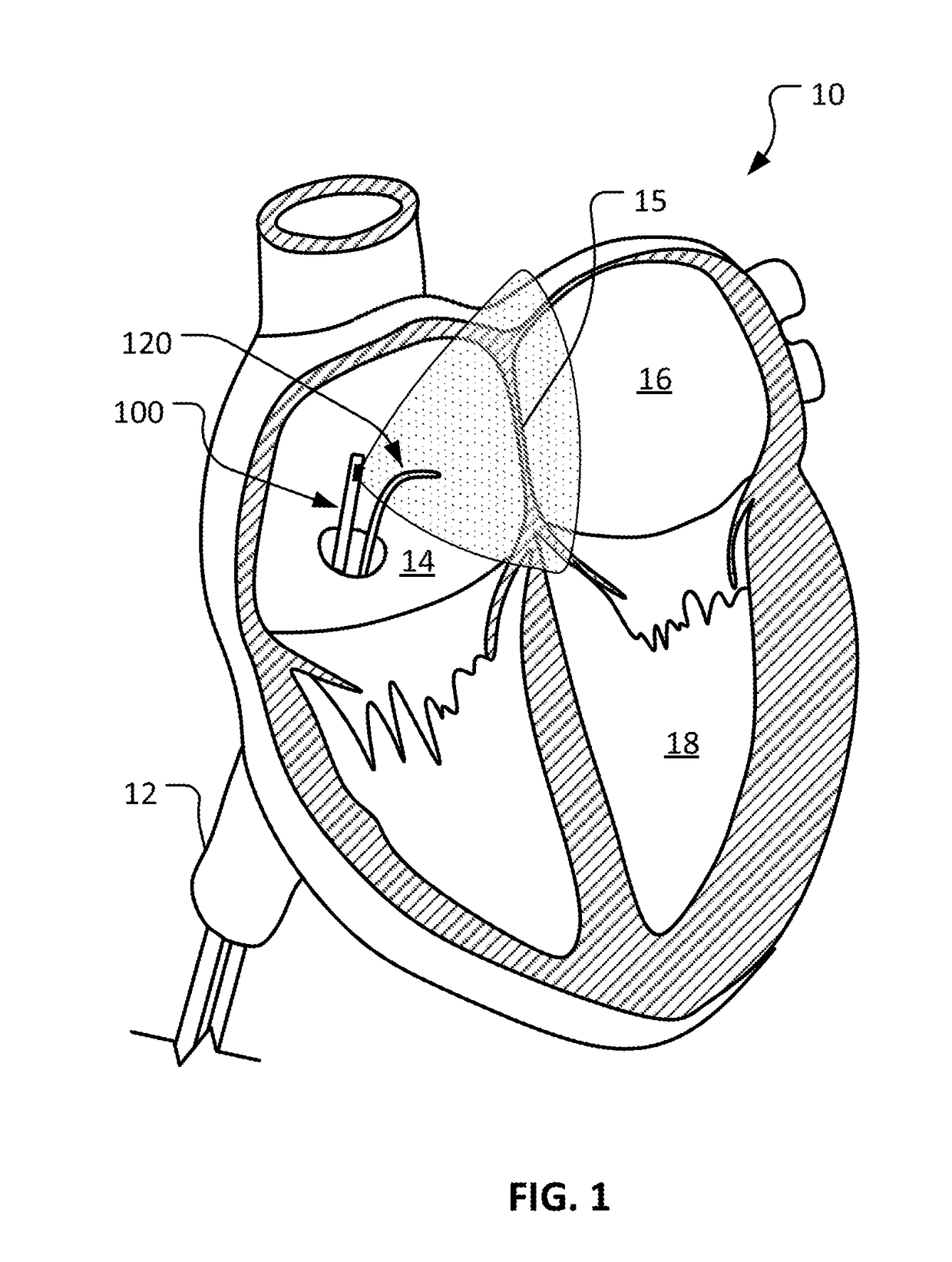 Intra-cardiac echocardiography with magnetic coupling